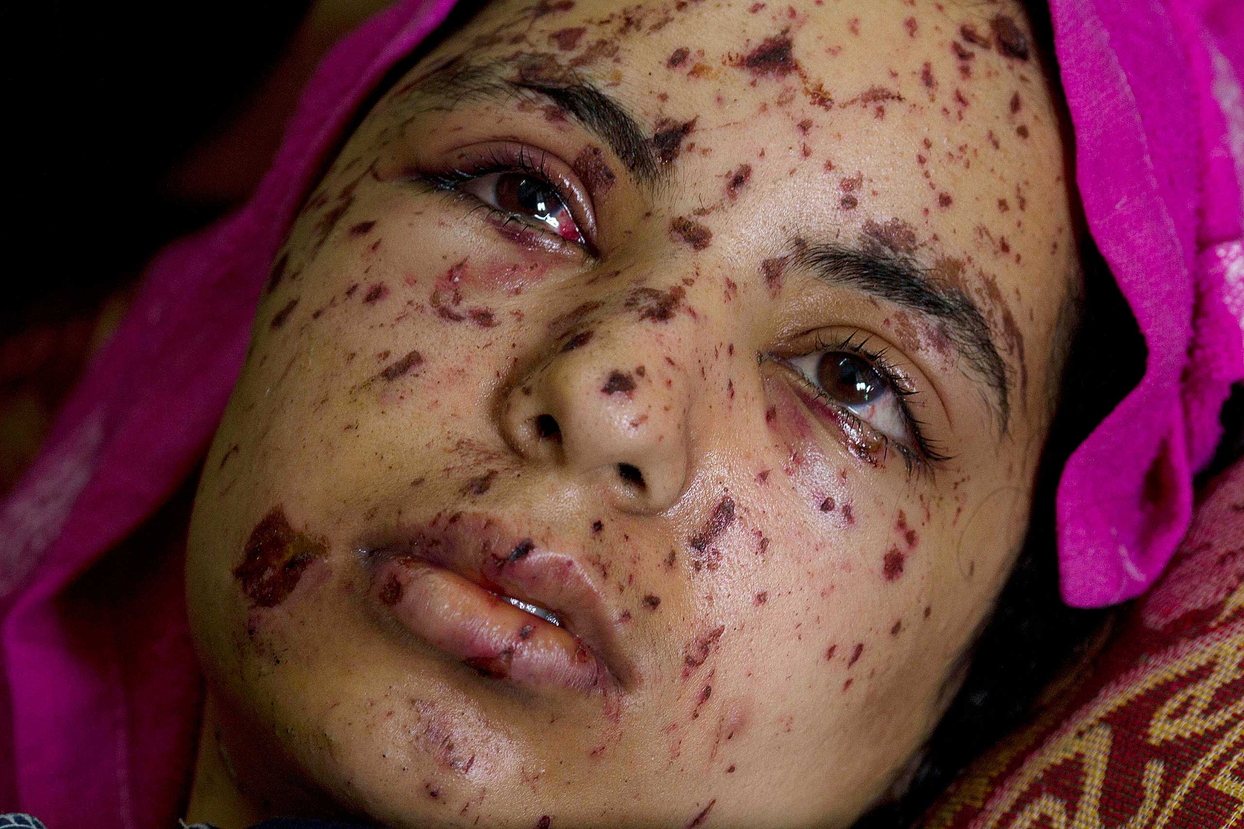 Rawya abu Jom'a, 17, at the Shifa Hospital in Gaza City, July 22,2014.
