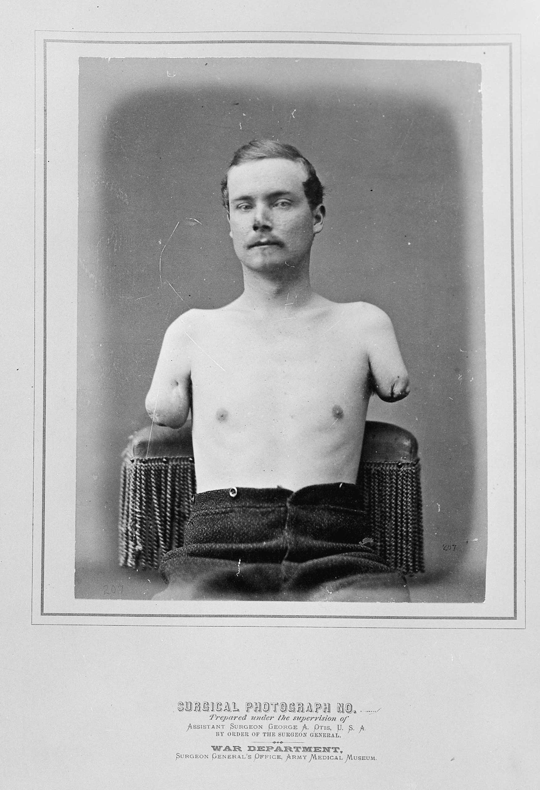 A surgical photo from the Surgeon General's War Department shows an injured soldier with both arms amputated.