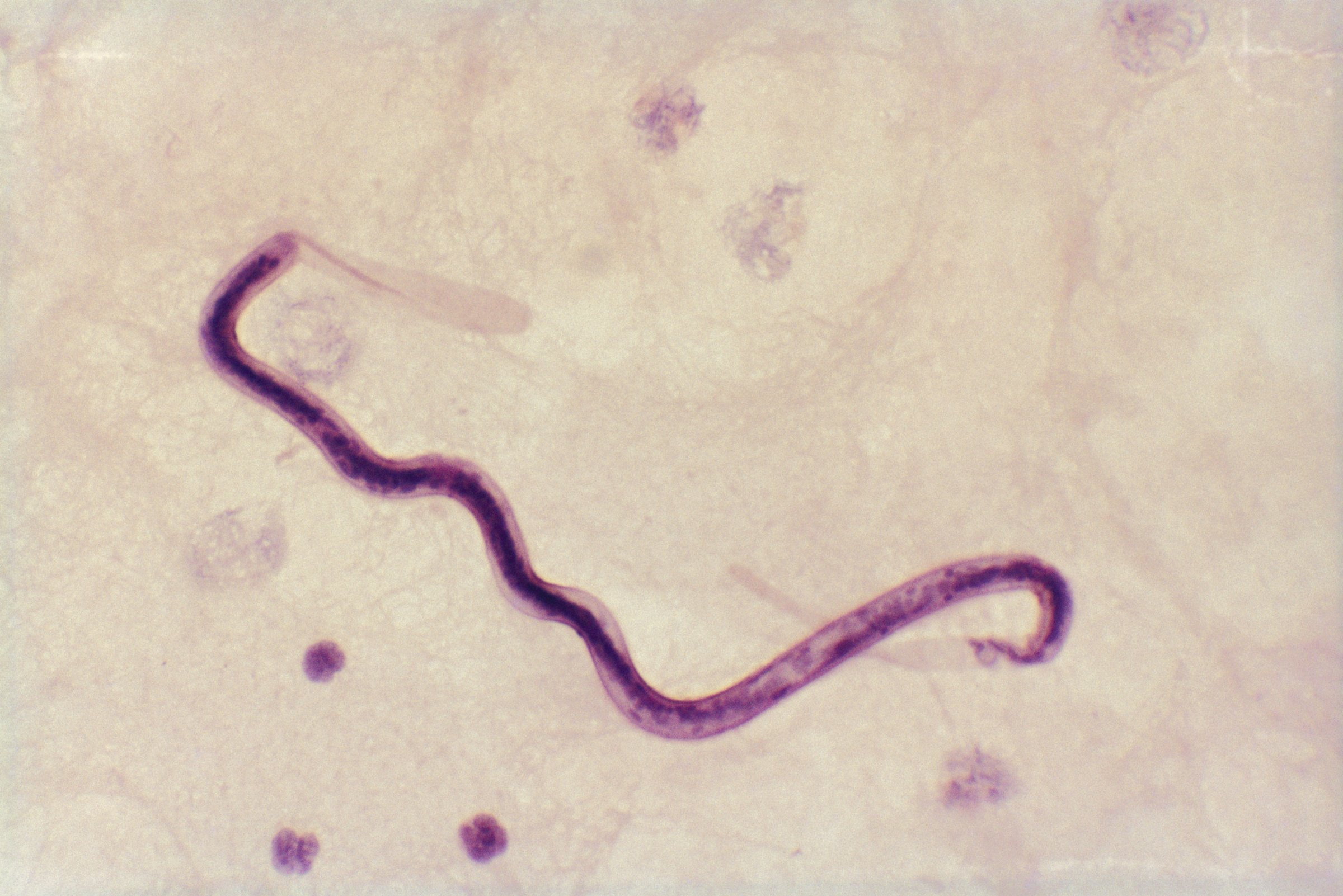 loa loa worm parasite