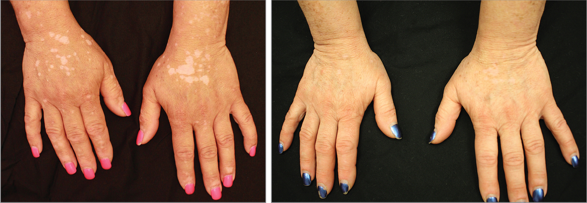 skin pigmentation arthritis