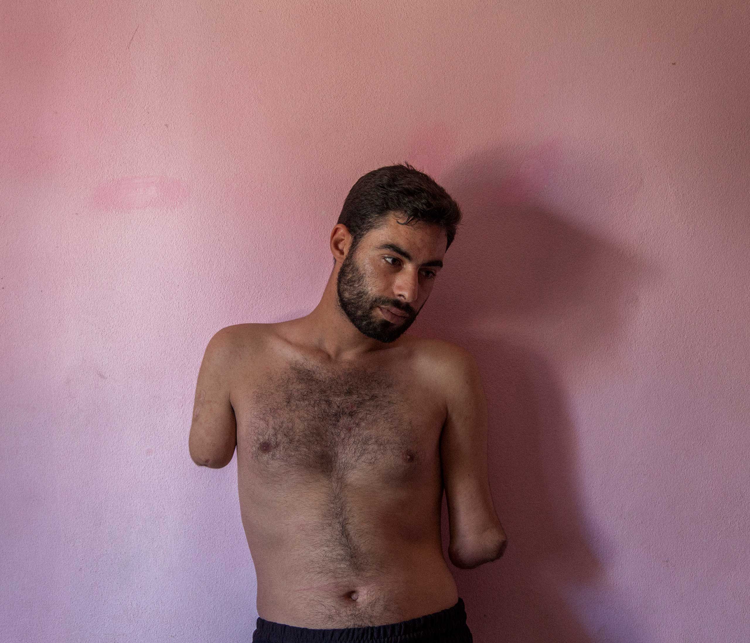 Mohammed, 22, was injured in March 2013 when his family home in Qousyr, Syria was hit by government shelling. He was living as a refugee with his wife and young child in Tripoli, Lebanon but was awaiting resettlement in Scandinavia. Aug. 2014.