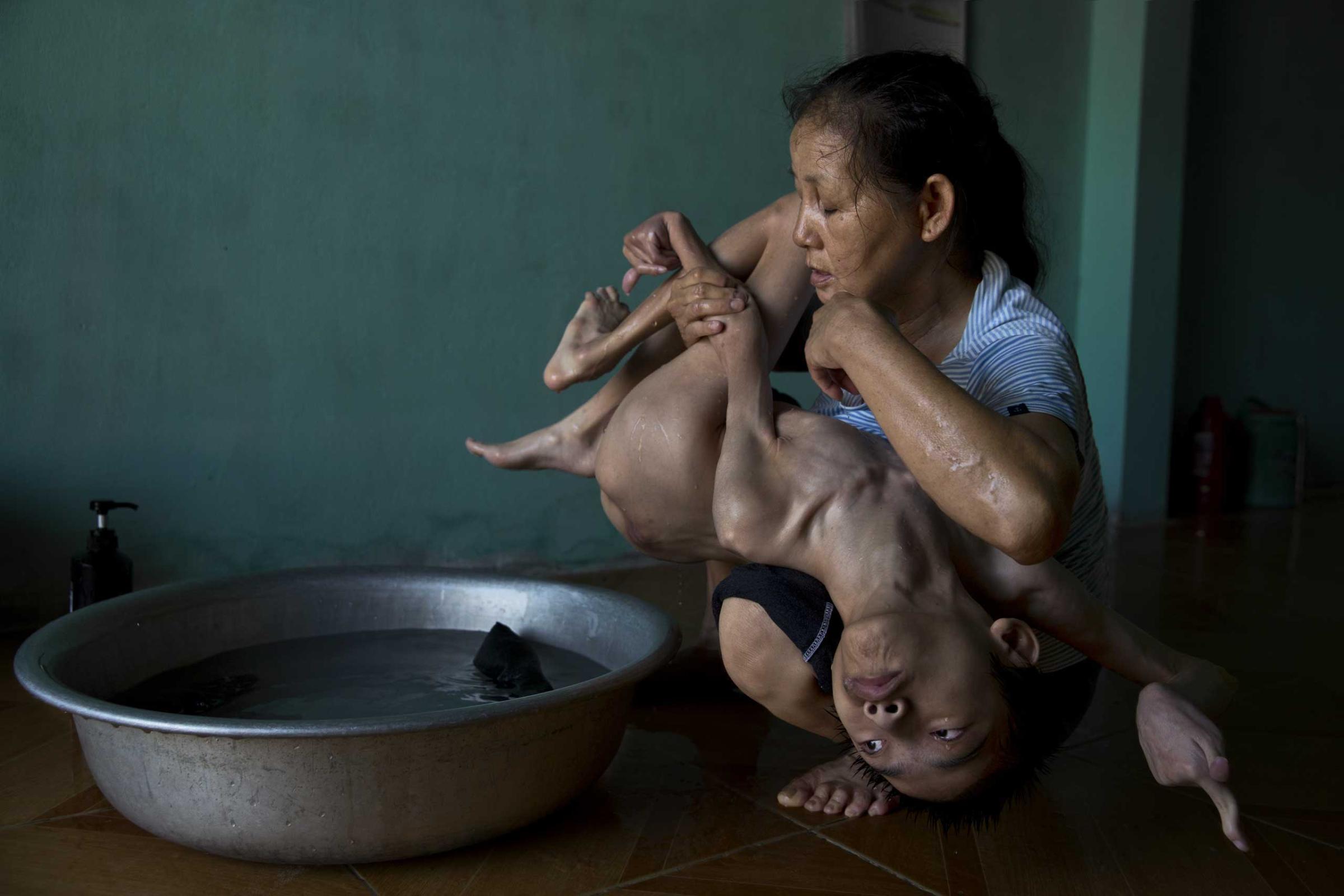Tran Thien Nhan, with severely malformed head and diminutive body, is an Agent Orange victim in Danang, Vietnam. His mother, Ngo Thi Tinh, and grandmother, The Thi Dao, care for him.
