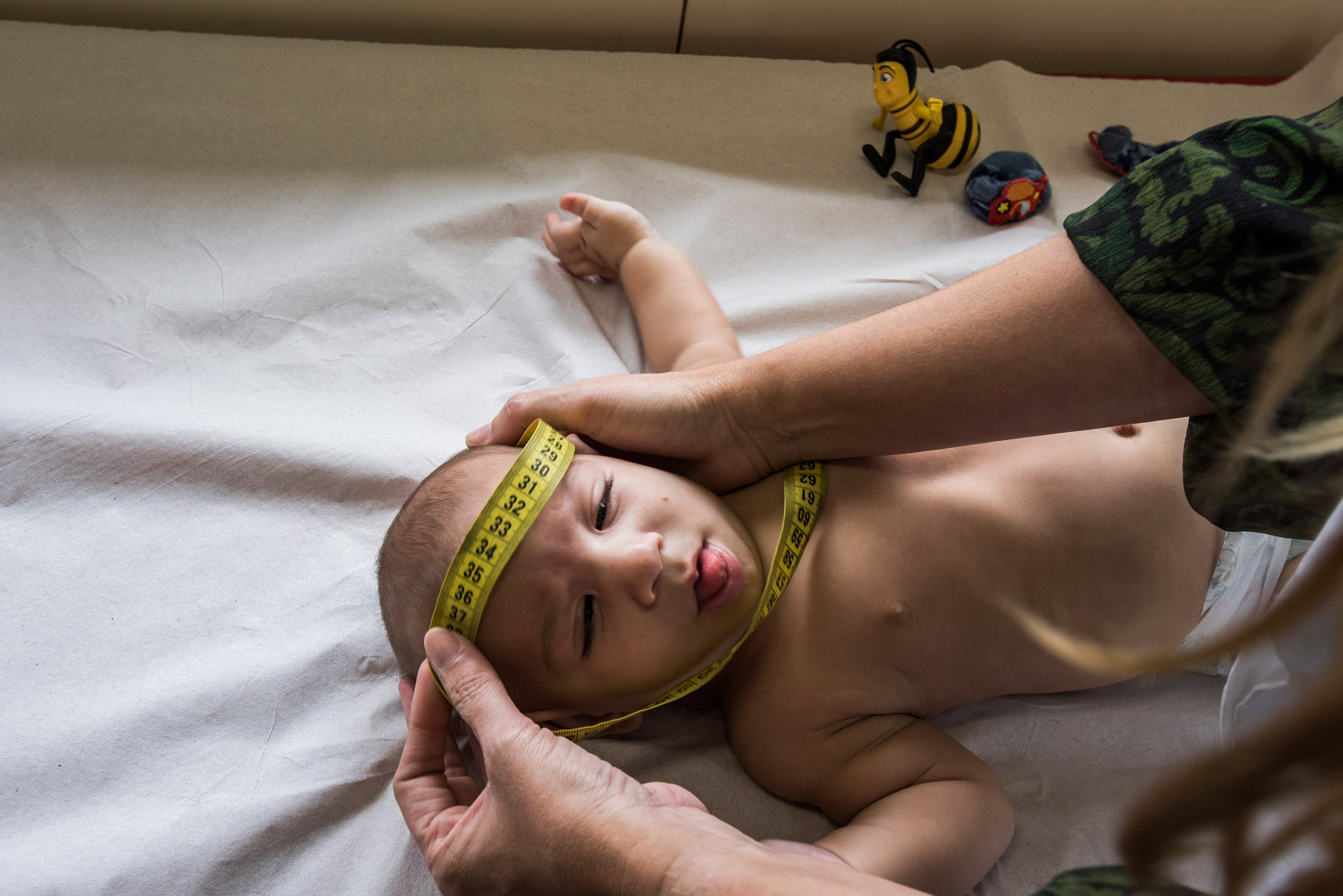 Dr. Vanessa Van Der Linden, a neurologist at the Associacao de Assistencia a Crianca Deficiente, measures the head of a baby with microcephaly in Recife, Brazil, Feb. 1, 2016. This center has seen 69 children with microcephaly so far.