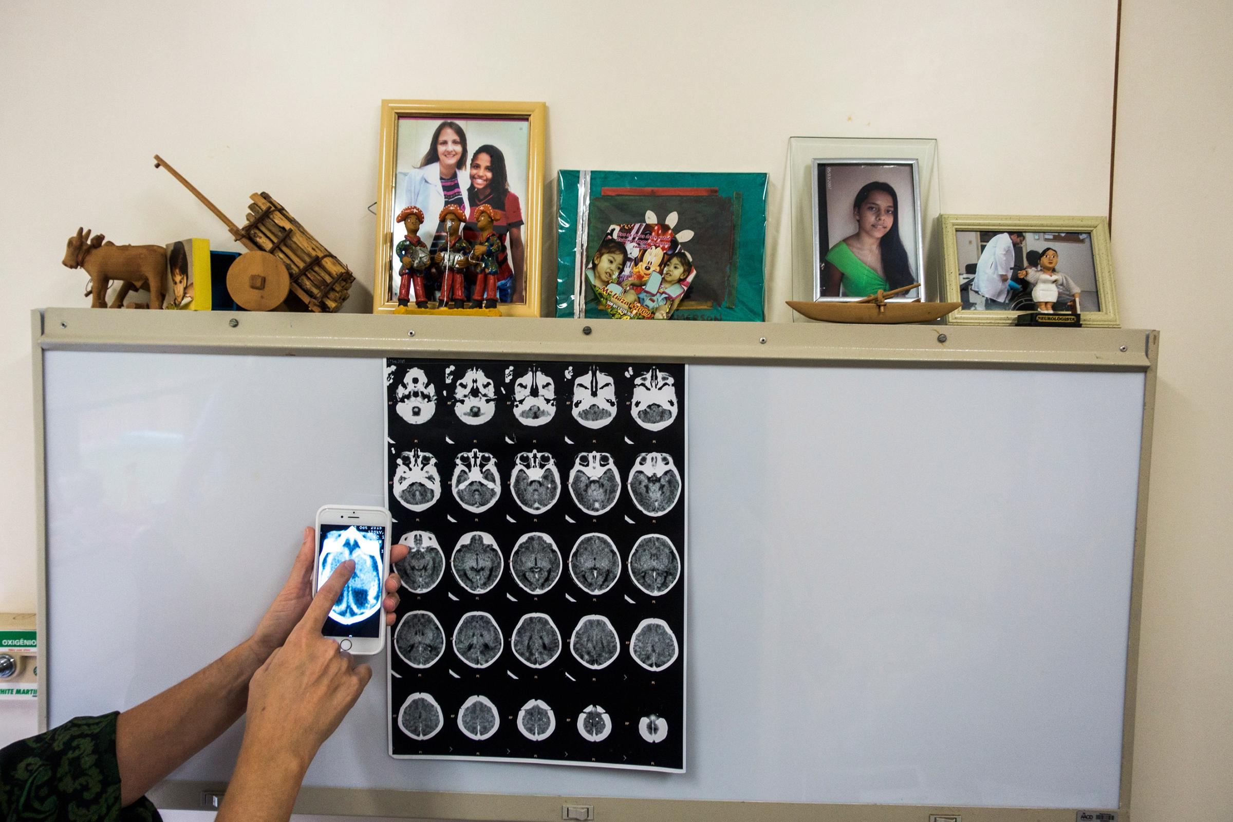 Dr. Vanessa Van Der Linden shows brain scan images from a boy with microcephaly at the Associacao de Assistencia a Crianca Deficiente, a rehabilitation center for disabled children, in Recife, Brazil, Feb. 1, 2016.