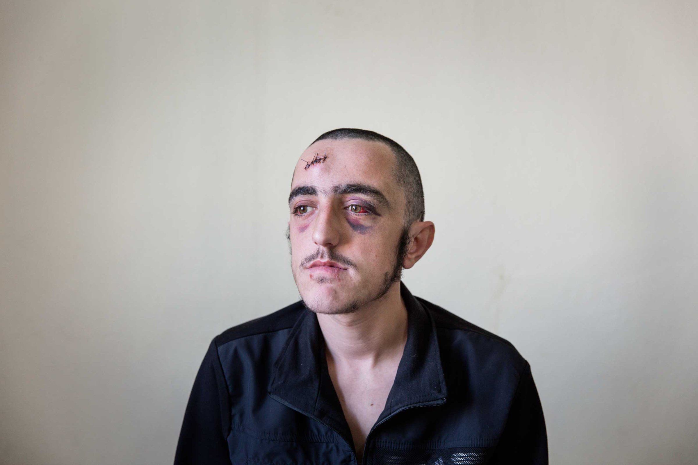 19-year-old Syrian rebel fighter Mamar Obein sits for a portrait at a small medical clinic inside Turkey where he was being treated for a head injury after he was hit by debris in what he said was a drone attack.