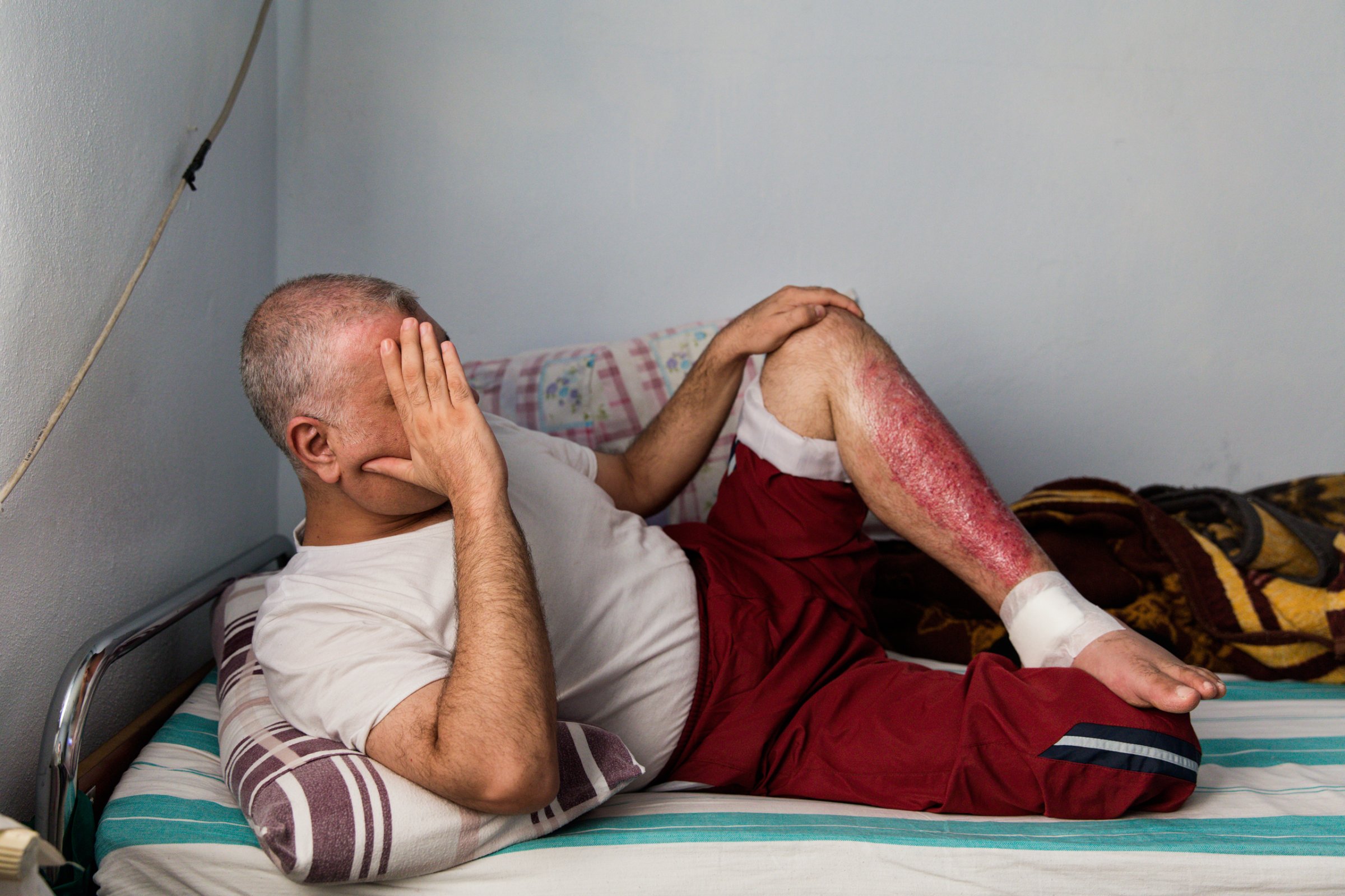A Syrian from Idlib sits at a medical clinic in Turkey, where he is being treated for injuries from a Russian air strike
