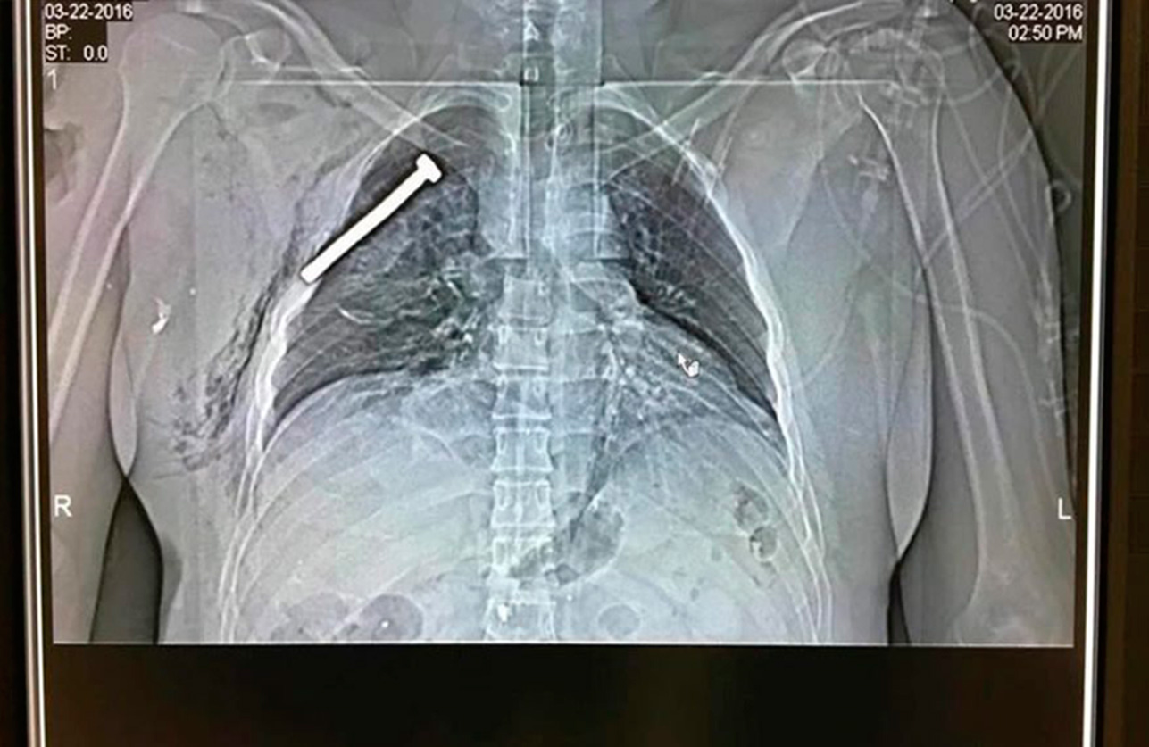The X-ray image of a person injured during the Brussels terrorist attacks shows a big nail or screw in the chest of the patient treated at the Military Hospital in Neder-over-Heembeek, in northern Brussels, March 22, 2016. EPA (EPA)