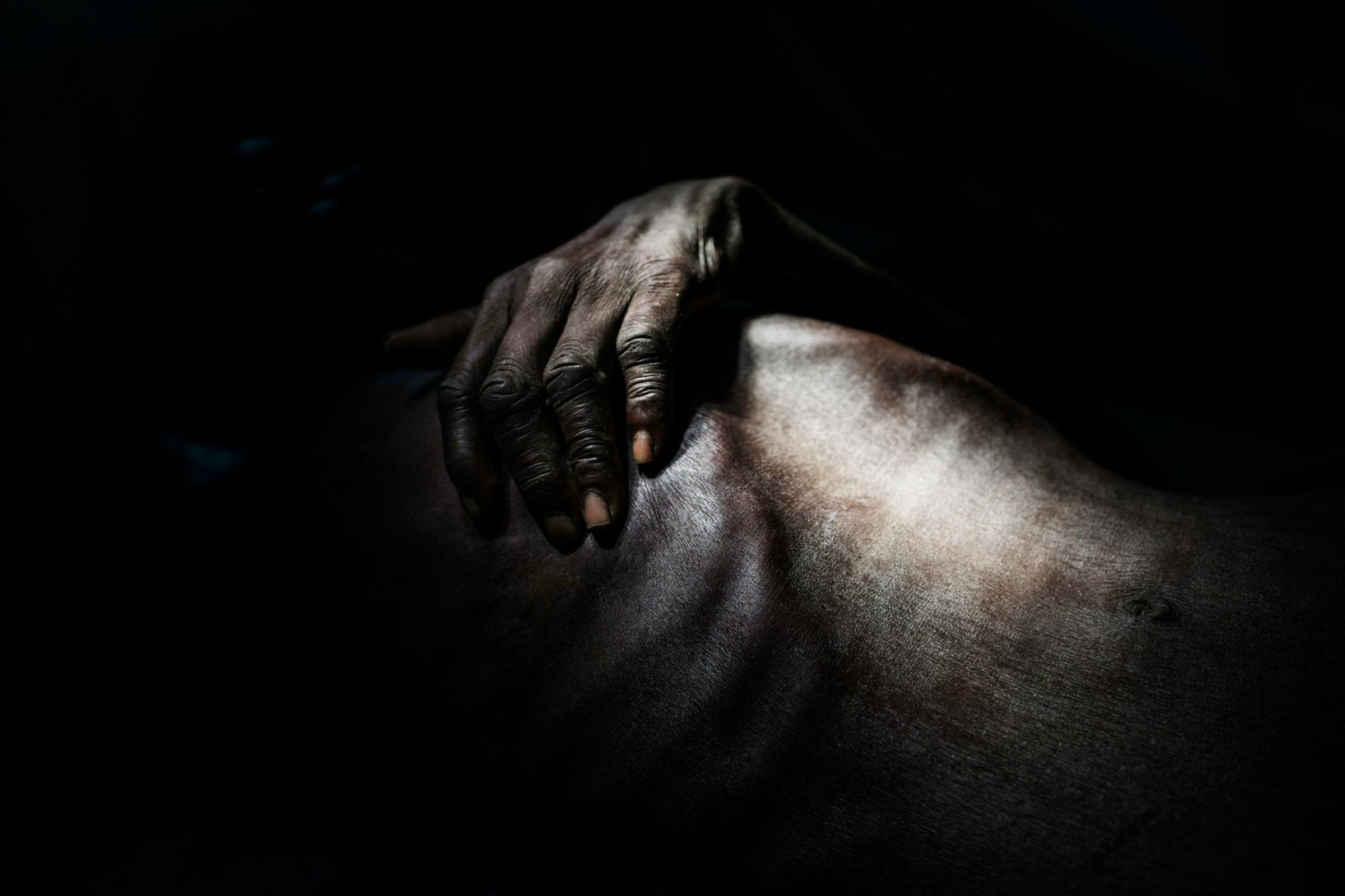 Per Chan, 60, rests inside the surgical ward in the Doctors Without Borders hospital in Lankien, Jonglei State, South Sudan. He was shot in the leg while trying to escape a raid by government forces in his village near Leer in Unity State.
