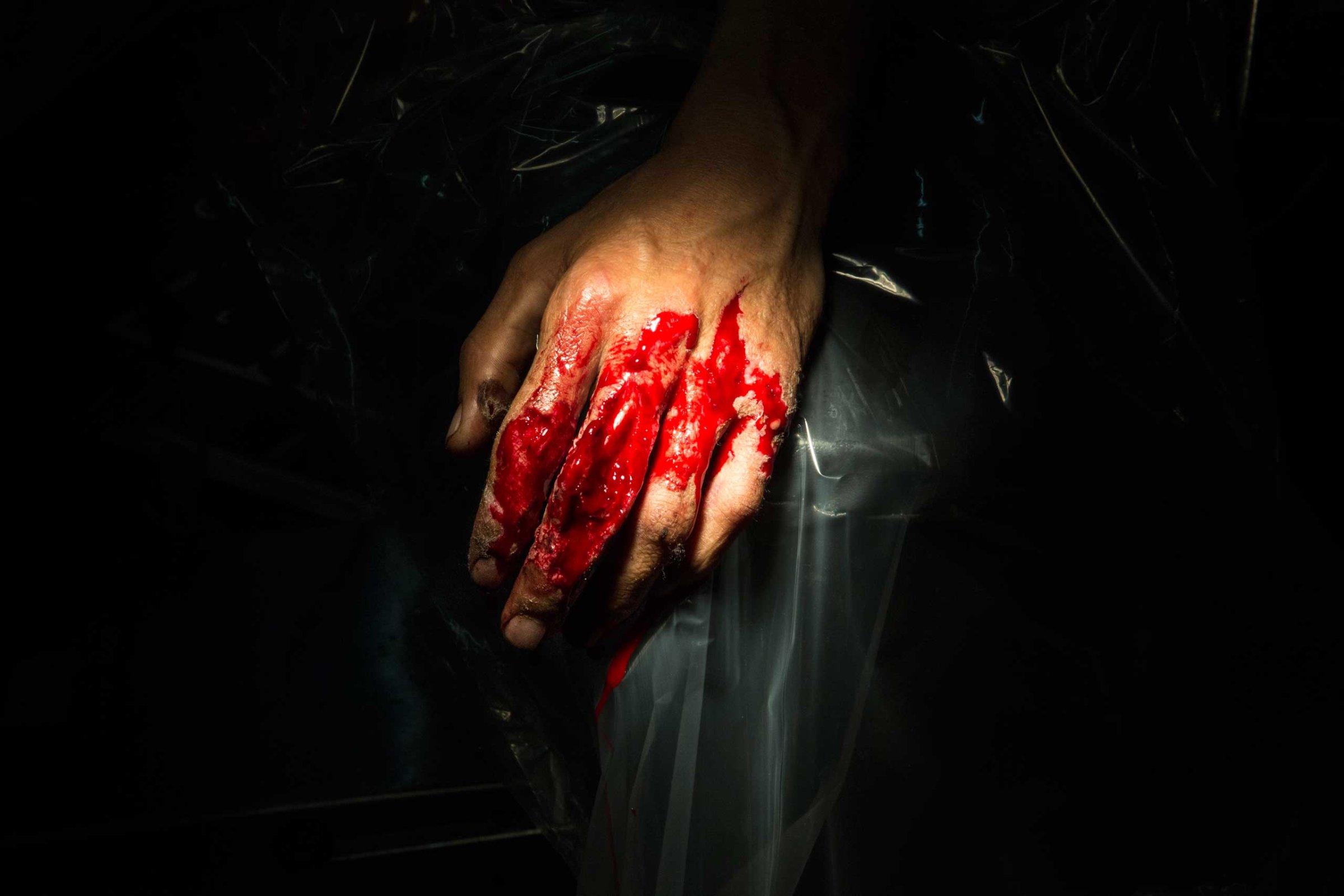 A bloody hand is seen in the operation room at the Emergency hospital in Lashkar Gah, Afghanistan on March 26, 2015.
