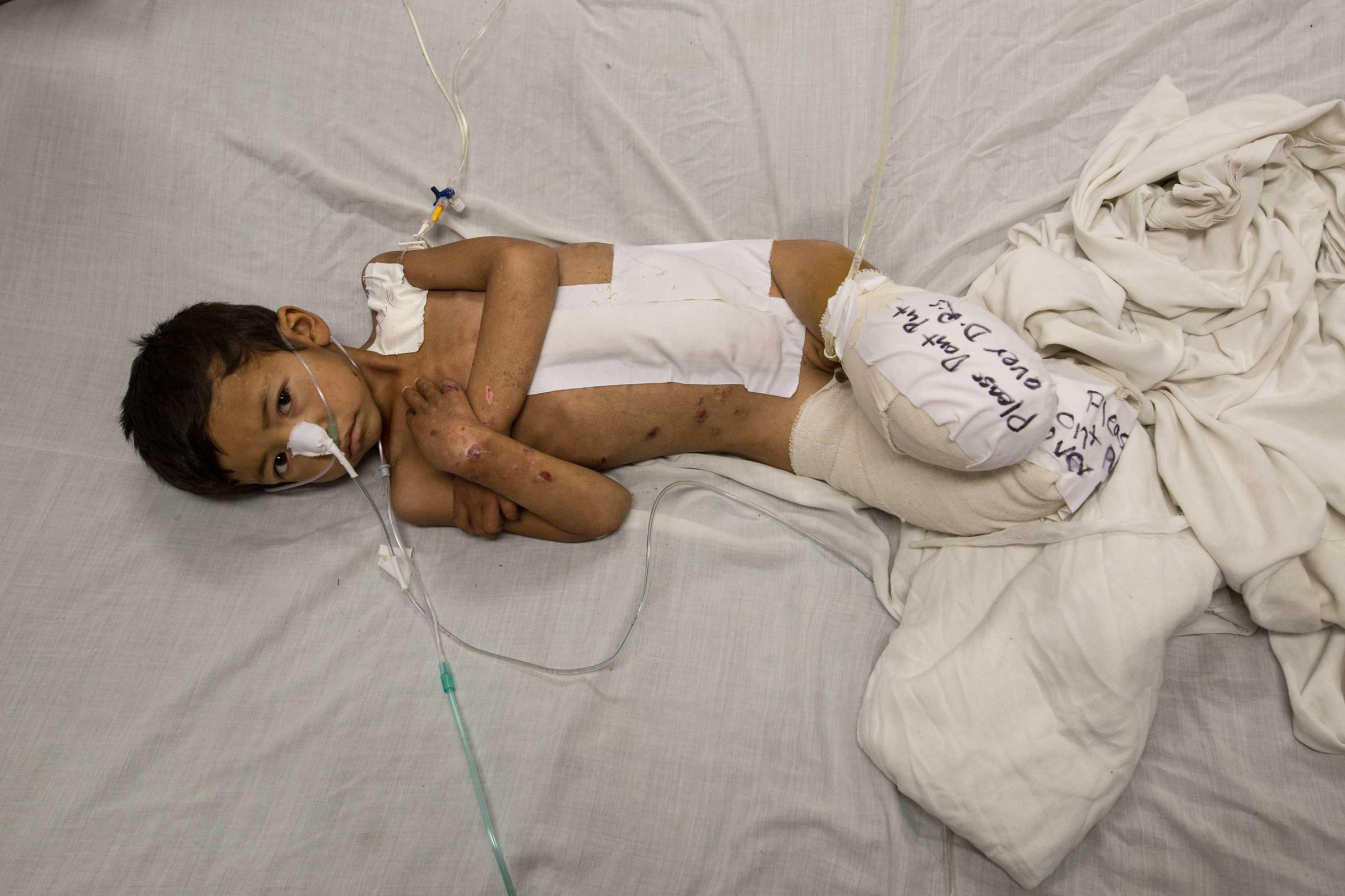 Kabir, 5, from Faryab lays in bed at the Emergency hospital in Kabul on April 3, 2016. He is a victim of a rocket attack, lost both of his legs along with his sister and brother who were also killed.