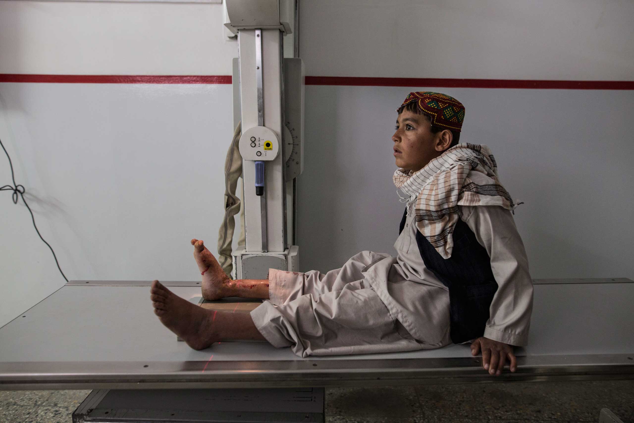 At the Emergency hospital a Pashtun boy waits for an X-ray on his leg from a mine injury in Kabul on March 29, 2016.