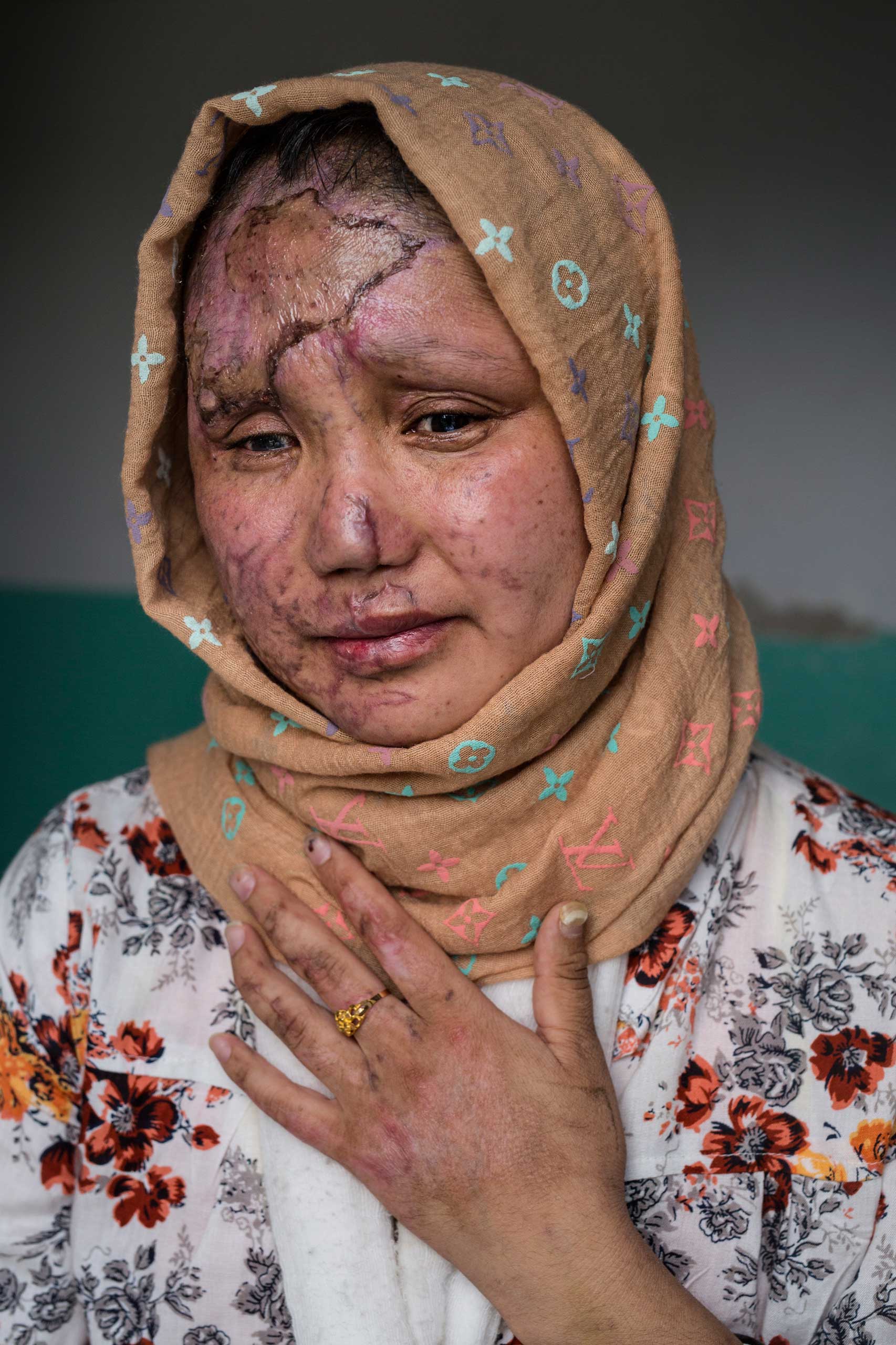 Razia Noorizada Didar, 30, was one of the seriously wounded victims that worked with Tolo TV for a decade. Razia has a lost sight in her left eye, and has several fractured bones. Her face is scarred from burns and shrapnel. The employees had finished a day’s work at Tolo TV, one of Afghanistan’s largest entertainment channels, when they boarded a company bus in Kabul on April 9, 2016. It was rammed by a car driven by a Taliban suicide bomber. Seven people were killed and at least 25 wounded in the attack.