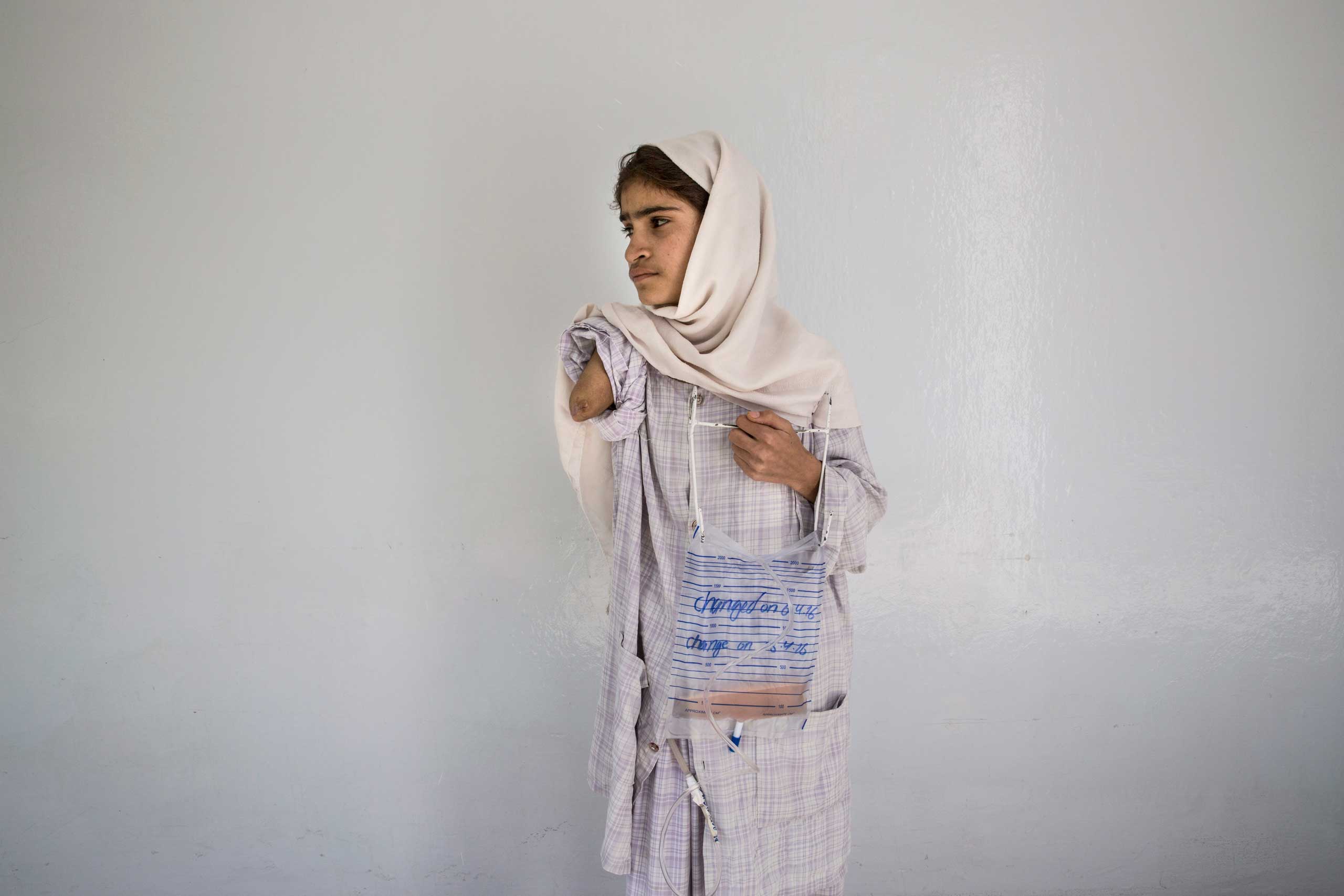 Madina, 12, lost her arm, when a rocket hit her home in Paktia, Kabul on April 6, 2016. She is recovering from an operation from complications with her pancreas at the Emergency hospital.