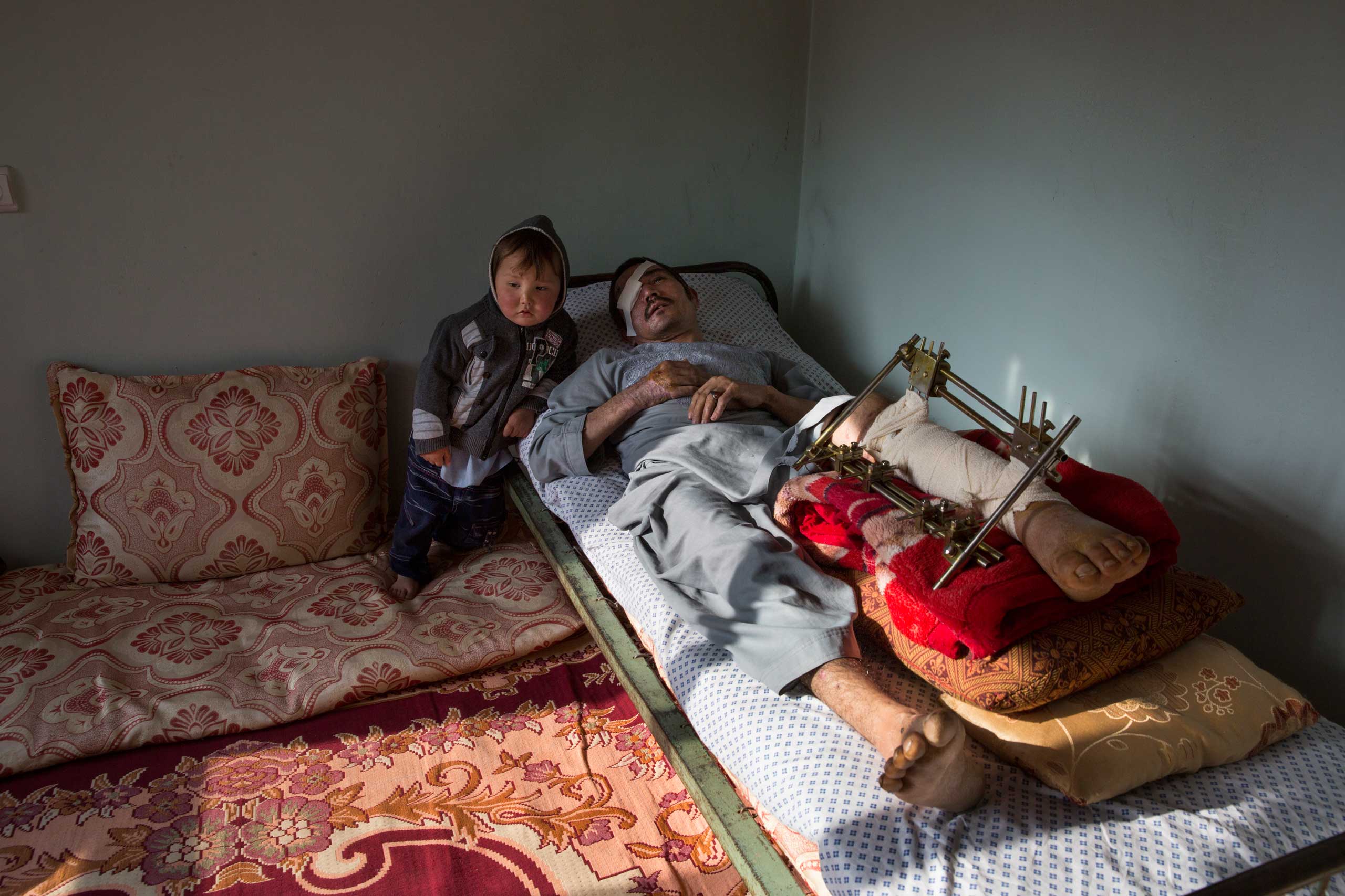 Abdul Hussain Ayoobi, is seen at home with his son Ali Akbar, 3. Abdul, a carpenter was one of the seriously wounded victims for Tolo TV. The employees had finished a day’s work at Tolo TV, one of Afghanistan’s largest entertainment channels, when they boarded a company bus in Kabul on April 9, 206. It was rammed by a car driven by a Taliban suicide bomber. Seven people were killed and at least 25 wounded in the attack.