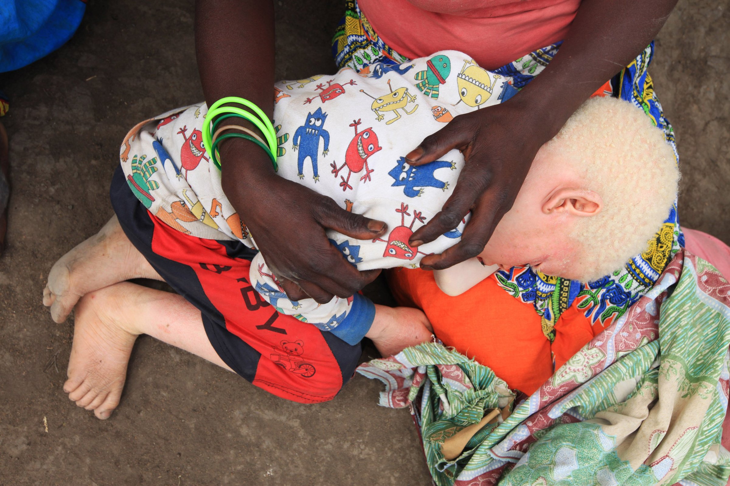 Edna Cedrick, 26, holds her surviving albino son after his twin brother who had albinism was snatched from her arms, in Machinga north east of Blantyre, Malawi, May, 24, 2016.