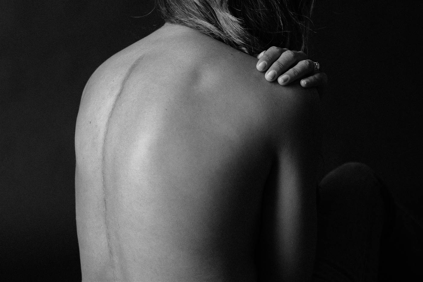 why-i-love-my-scoliosis-scar