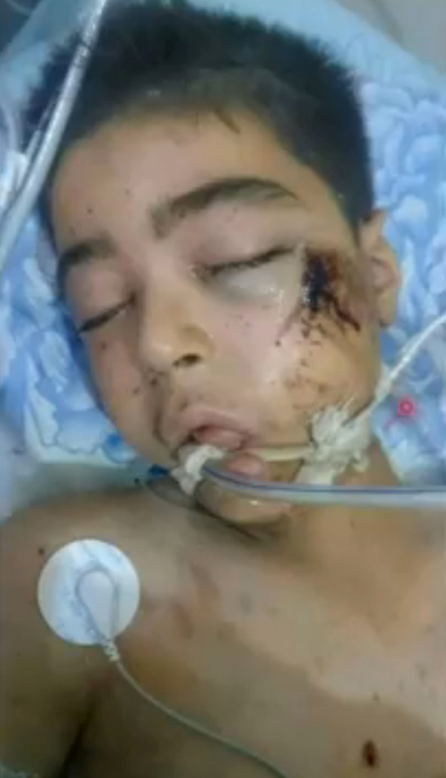 A still image taken on Aug. 21, 2016, from a video uploaded by the Aleppo Media Center shows Ali Daqneesh, the 10-year-old brother of Omran Daqneesh, in a hospital bed in Aleppo shortly before his death.