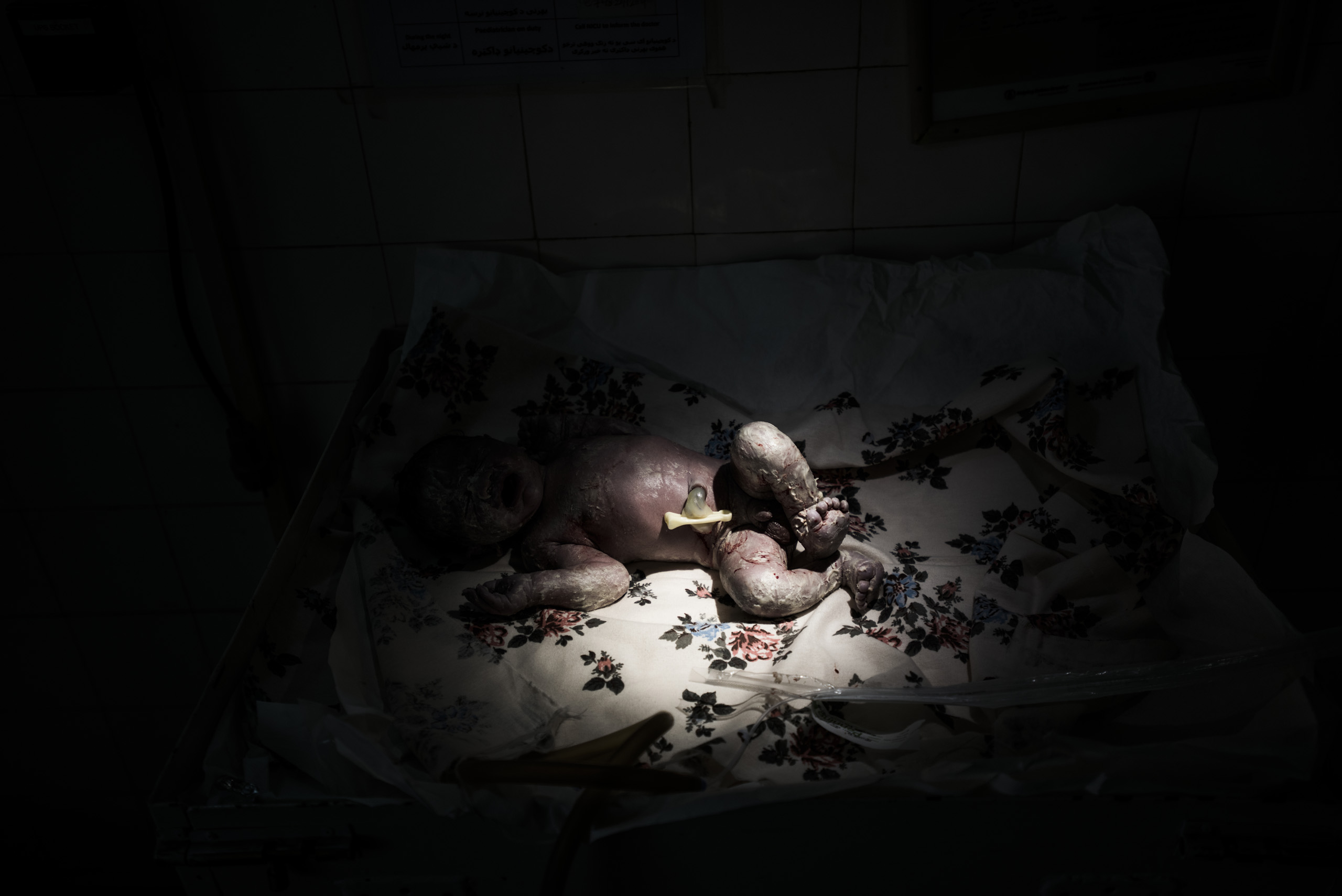A newborn after a cesarean section in a hospital run by Doctors Without Borders, Lashkar Gah, Helmand, Afghanistan, June 2016.