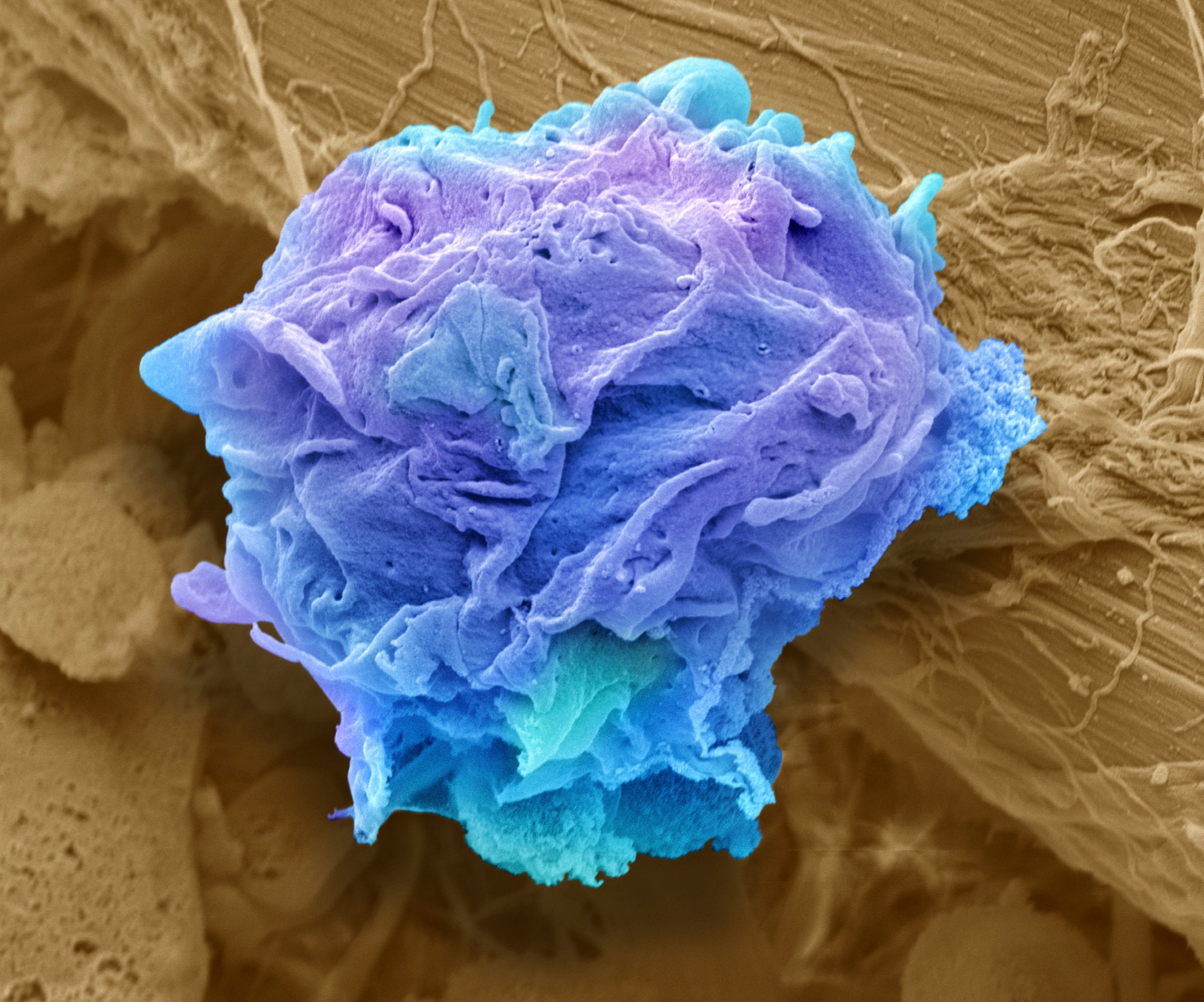 Lymphoma cancer cell. Coloured scanning electron micrograph (SEM) of a lymphoma cell. A lymphoma is a cell of the immune system that has become cancerous. The cell becomes immortal and can grow indefinitely. A number of these cells will form a tumour. Lymphomas most commonly occur in the lymph nodes and spleen, which are rich in tissue containing lymphocytes, and can spread to the liver and bone marrow. Lymphoma cancers are classified into either Hodgkin's lymphoma (presence of Reed-Sternberg cells) or non- Hodgkin's lymphoma. Treatment is with chemotherapy and radiation therapy and is often successful. Magnification: x9000 when printed at 10 centimetres high.