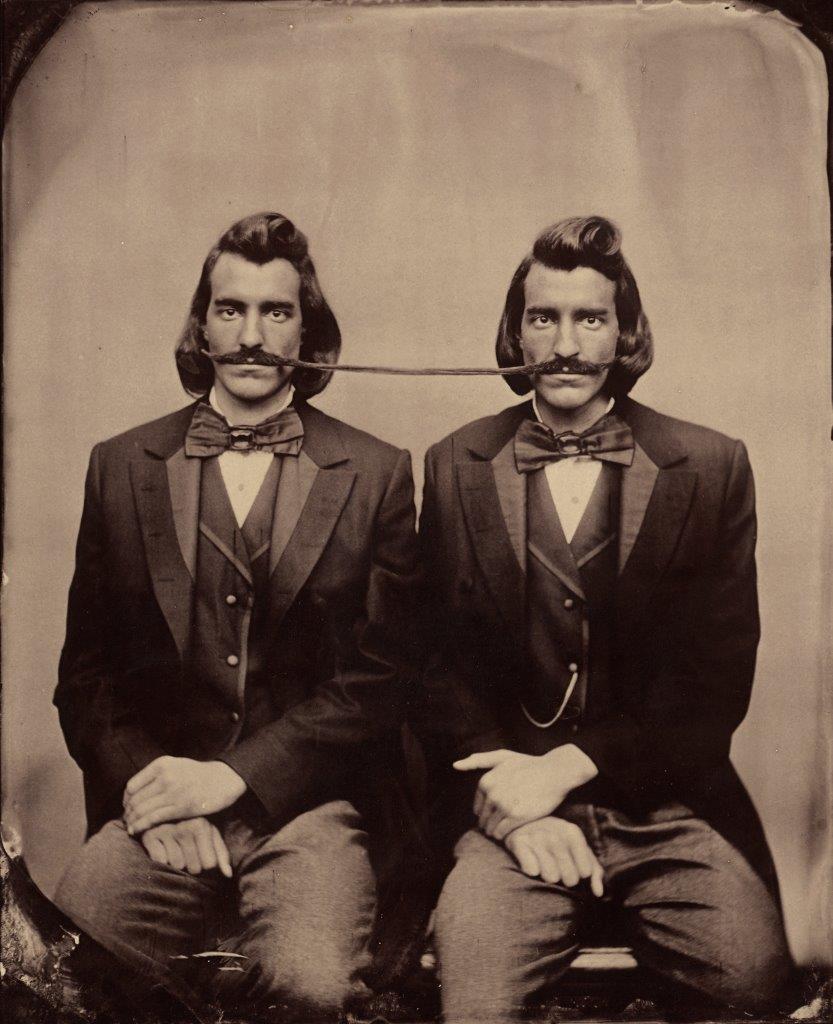 Conjoined Twins, undated. Albumen print from wetplate negative.