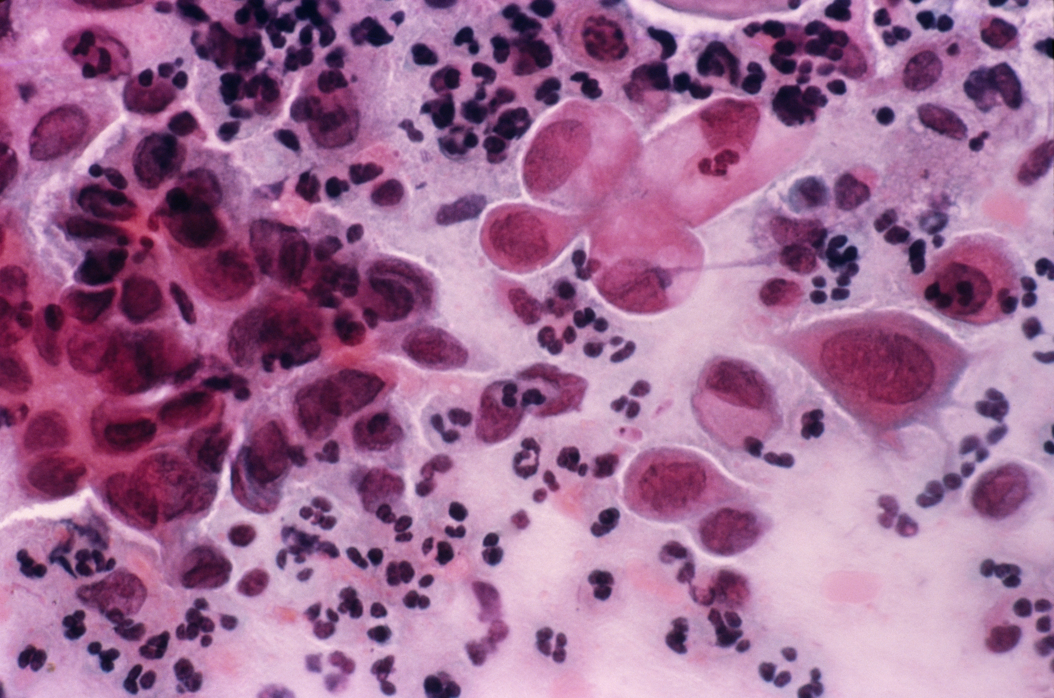 Light micrograph of a vaginal smear showing cancer cells (large pink cells with purple nuclei).