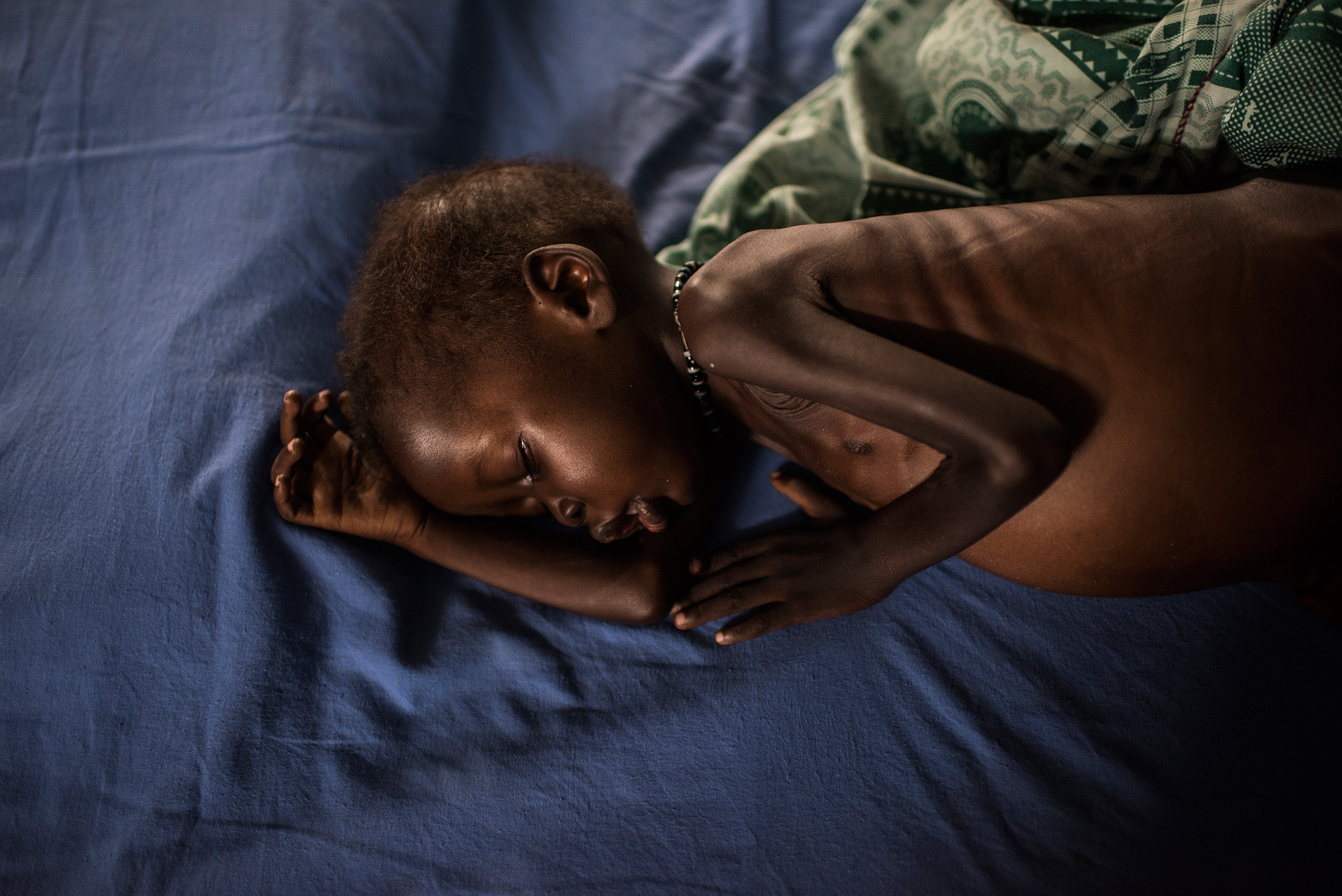 A severely malnourished child from the South Sudanese town of Leer receives treatment at the inpatient ward run by International Medical Corps at the Protection of Civilians site in Juba, South Sudan's capital, on March 22, 2016 (Lynsey Addario—Getty Images Reportage for TIME)