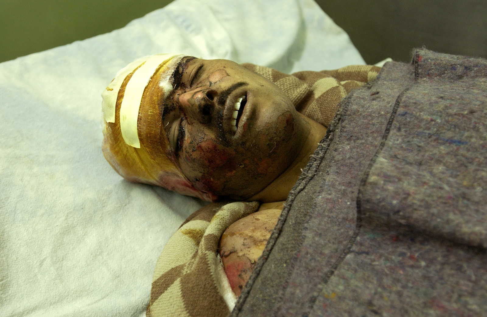 A wounded Iraqi man in Baghdad hospital after airstrikes in the days following the U.S. bombing of Baghdad, April 4, 2003.