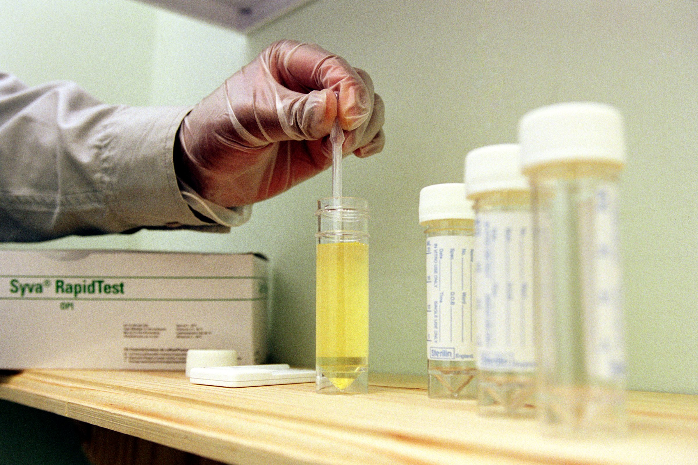 Drug counsellor testing urine for traces of drugs.
