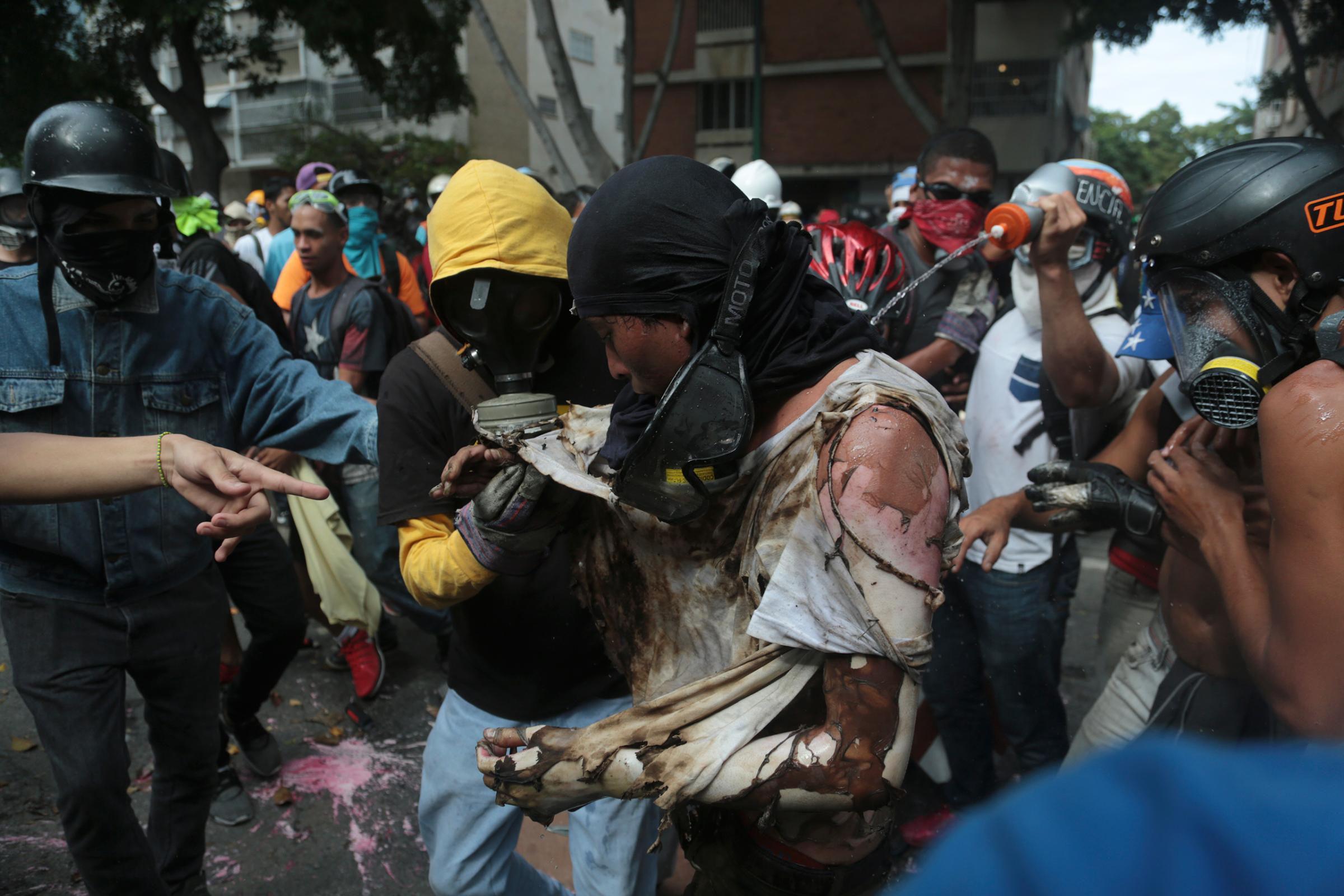 The man is aided by fellow protesters after he was burnt when demonstrators set fire to a Bolivarian National Guard motorbike as security forces block their march from reaching the National Assembly in Caracas, Venezuela, Wednesday, May 3, 2017.