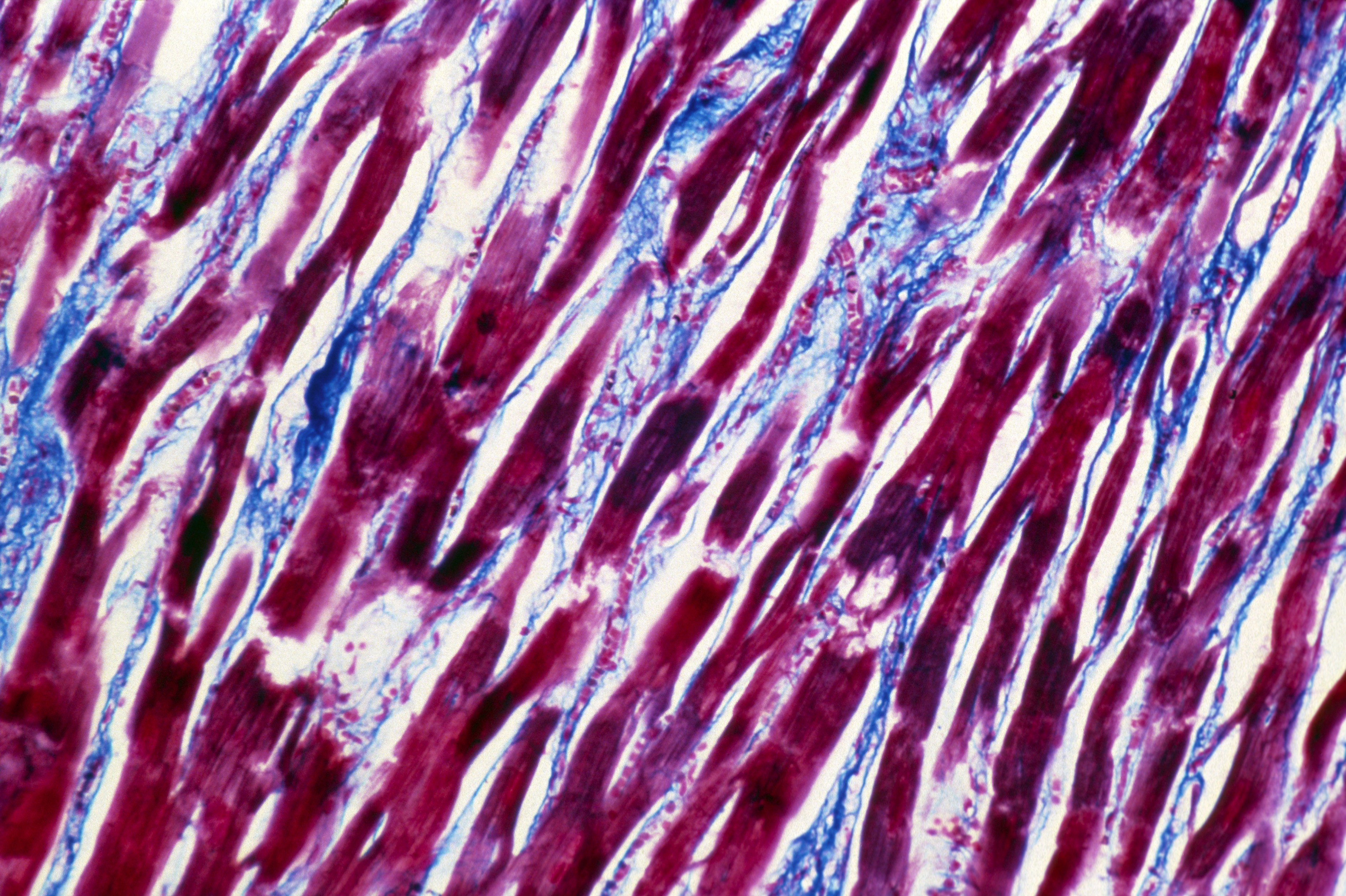 Light micrograph of human cardiac muscle with chronic myocarditis (inflammation). (Hanns-Frieder Michler—Science Photo Library/Getty Images)