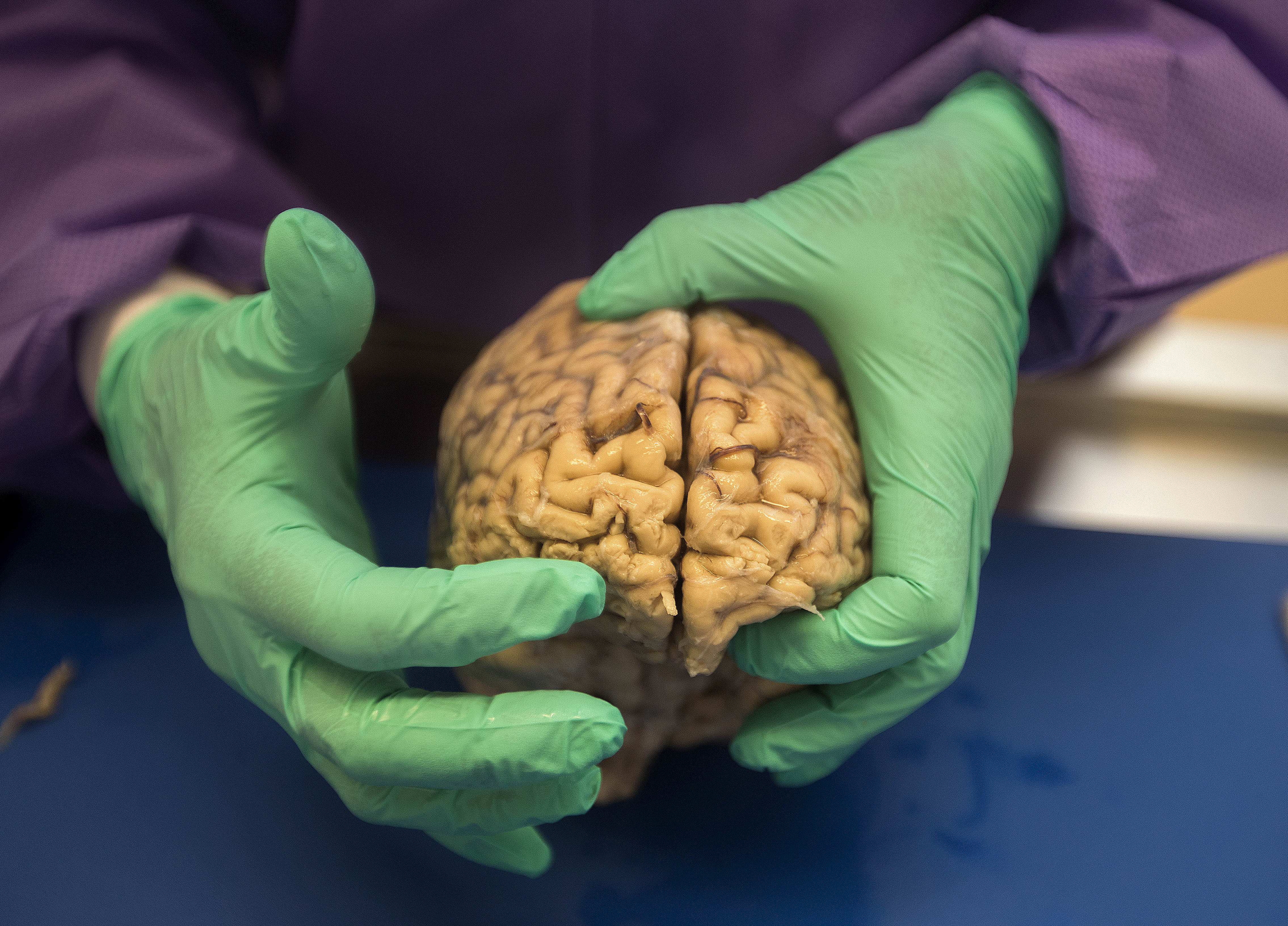 JUL. 12 2012: Dr. Ann C. McKee, Director of Boston University's CTE Center, does an autopsy on the brain of an NFL player who died in his 40s (Boston Globe&mdash;Boston Globe via Getty Images)