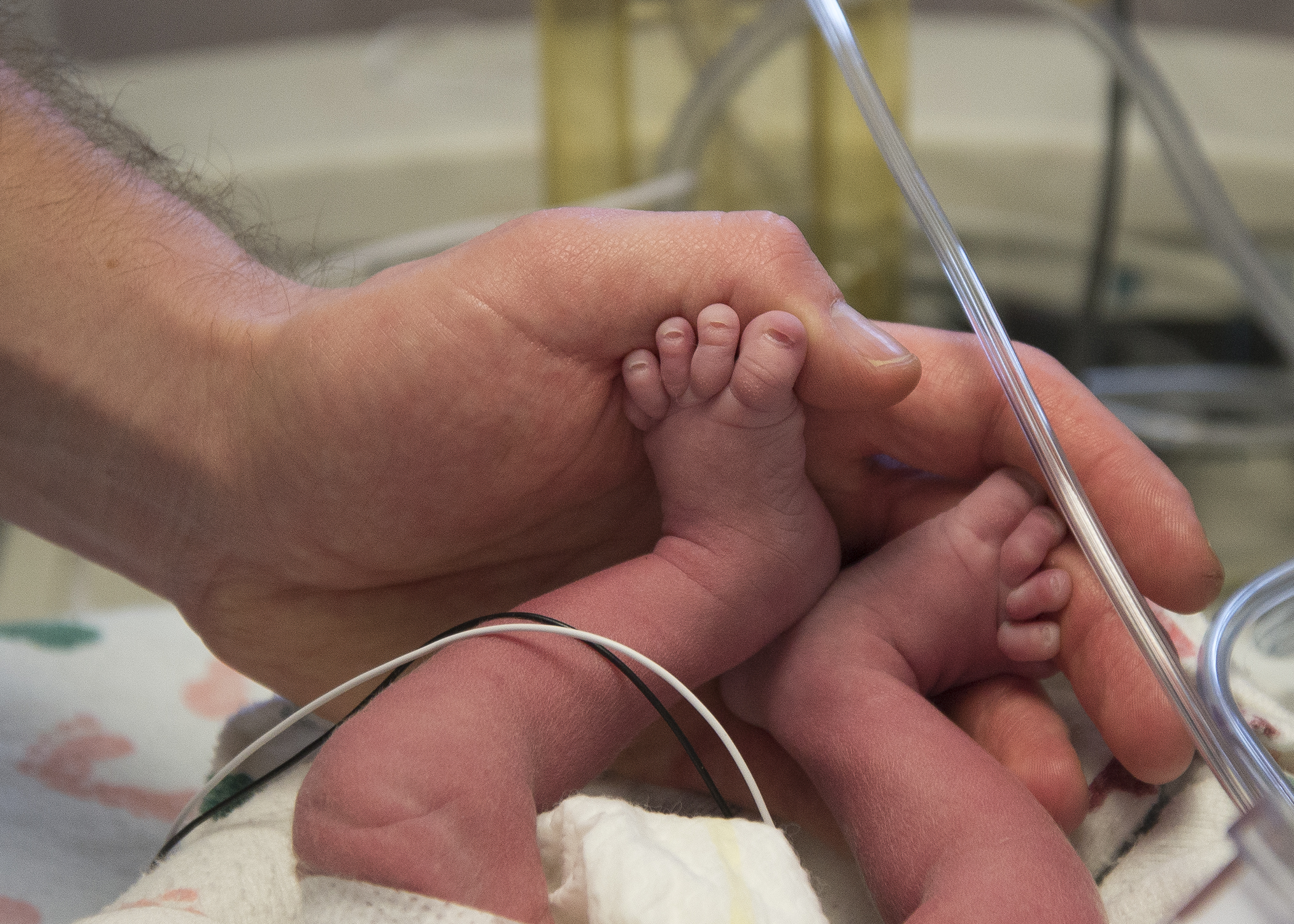 The baby's feet in the father's hands. (Baylor University Medical Center at Dallas)