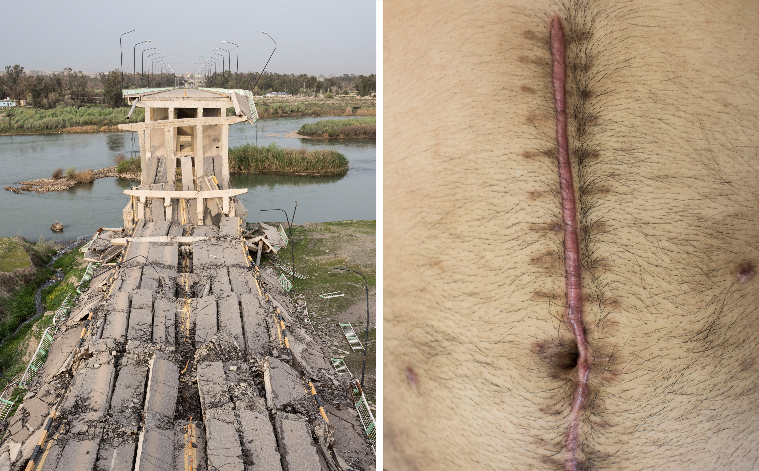 A destroyed bridge between the eastern and western sections of Mosul in April; a scar from a surgery to remove shrapnel from a car bomb at a Doctors Without Borders clinic in Baghdad in April. (Lorenzo Meloni—Magnum Photos)