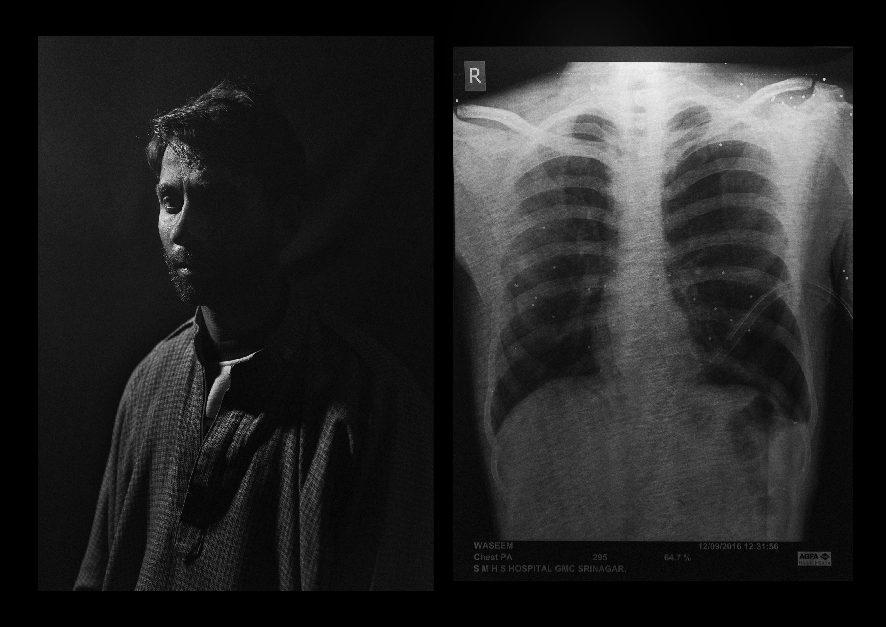 Shabkal Nazir Waseem, 25 years old, from Bijbehera. Police left him with one hundred pellets all over his upper body when they shot him on the Muslim holiday of Eid. Two lodged in each eye, leaving him almost totally blind. Four people were blinded by pellet guns in Kashmir on the day he was shot, he told Pasquarelli. (Camillo Pasquarelli)