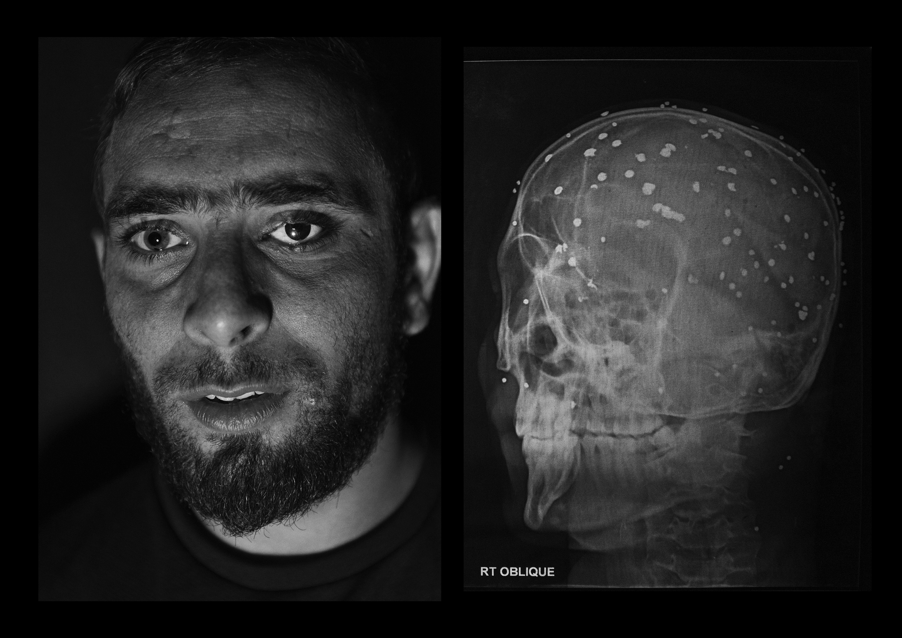 Danish Rajab Jhat, 24 years old, from Srinagar. His left eye was unsalvageable, so doctors replaced it with an artificial eyeball. He still has 90 pellets inside his body and from his right eye he can barely see shadows. (Camillo Pasquarelli)