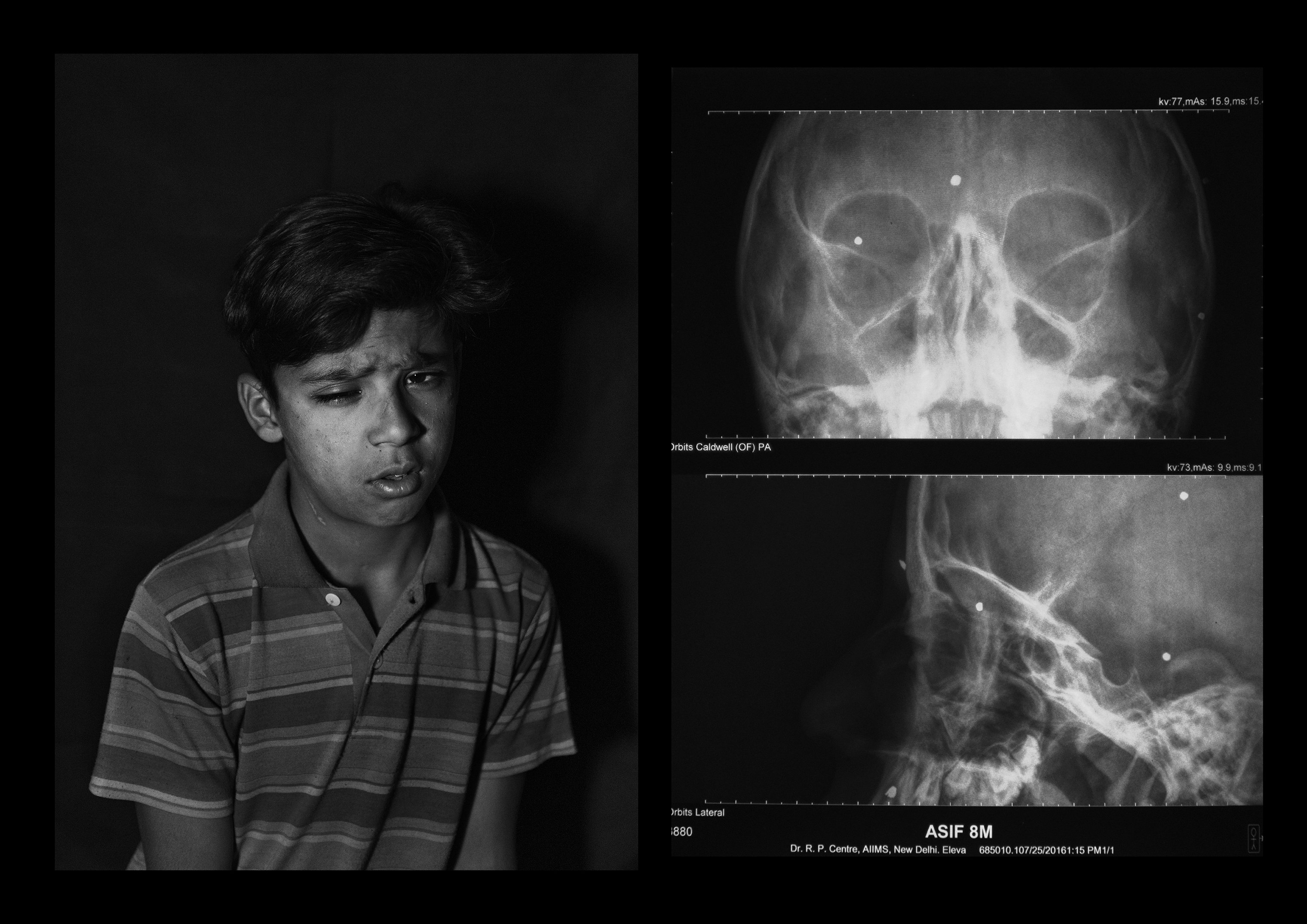 Asif Ahmad Sheikh, 10 years old, from Anantnag. Asif received one pellet in his right eye, losing vision entirely on that side. He told Pasquarelli the injury has caused lots of problems at school. (Camillo Pasquarelli)