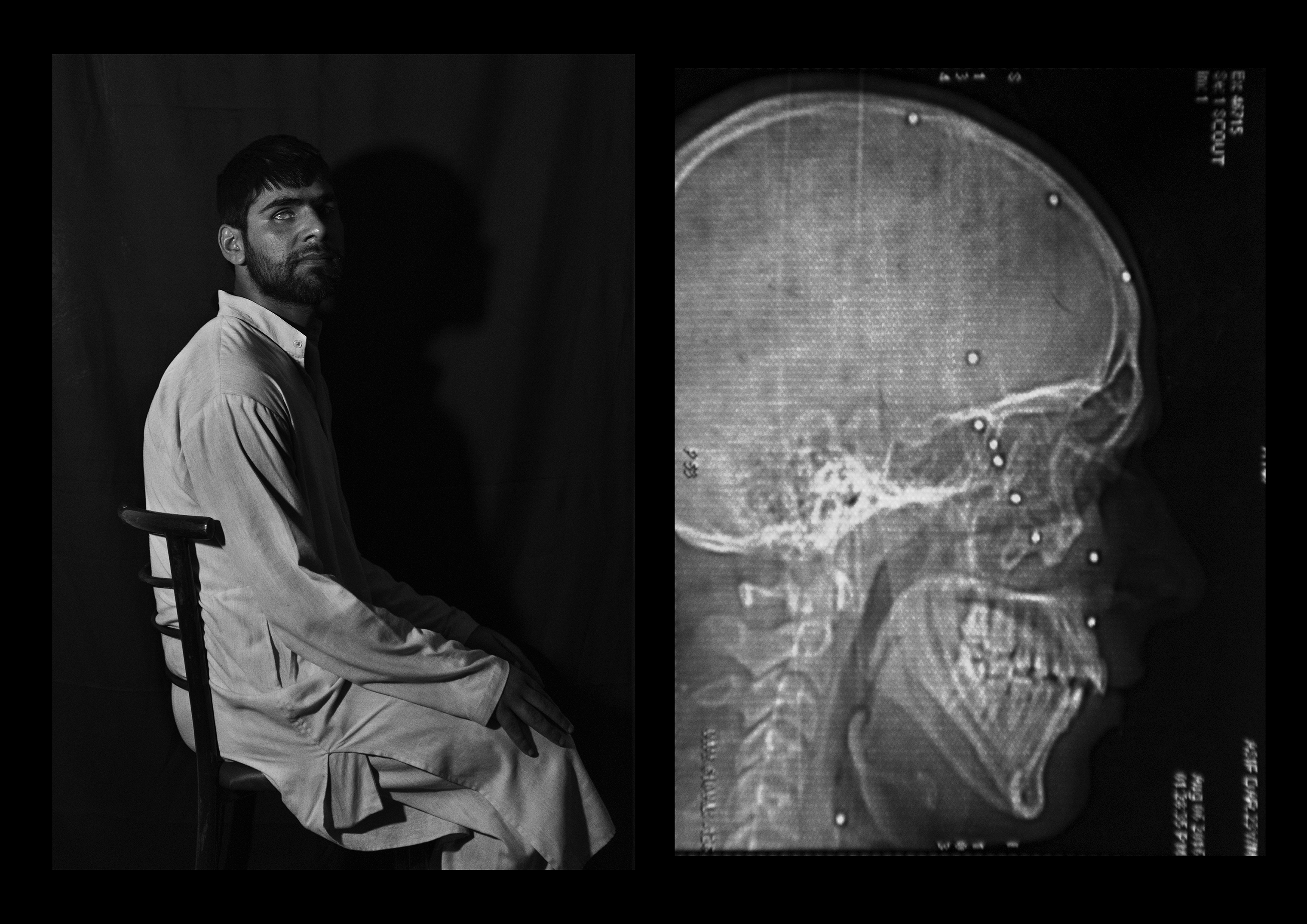Mohammad Asif Dar, 23 years old, from Baramulla. He says he was playing cricket when he was shot in the head, shoulder and chest. Despite eight surgeries, he only has 10% of his vision left in his right eye. (Camillo Pasquarelli)