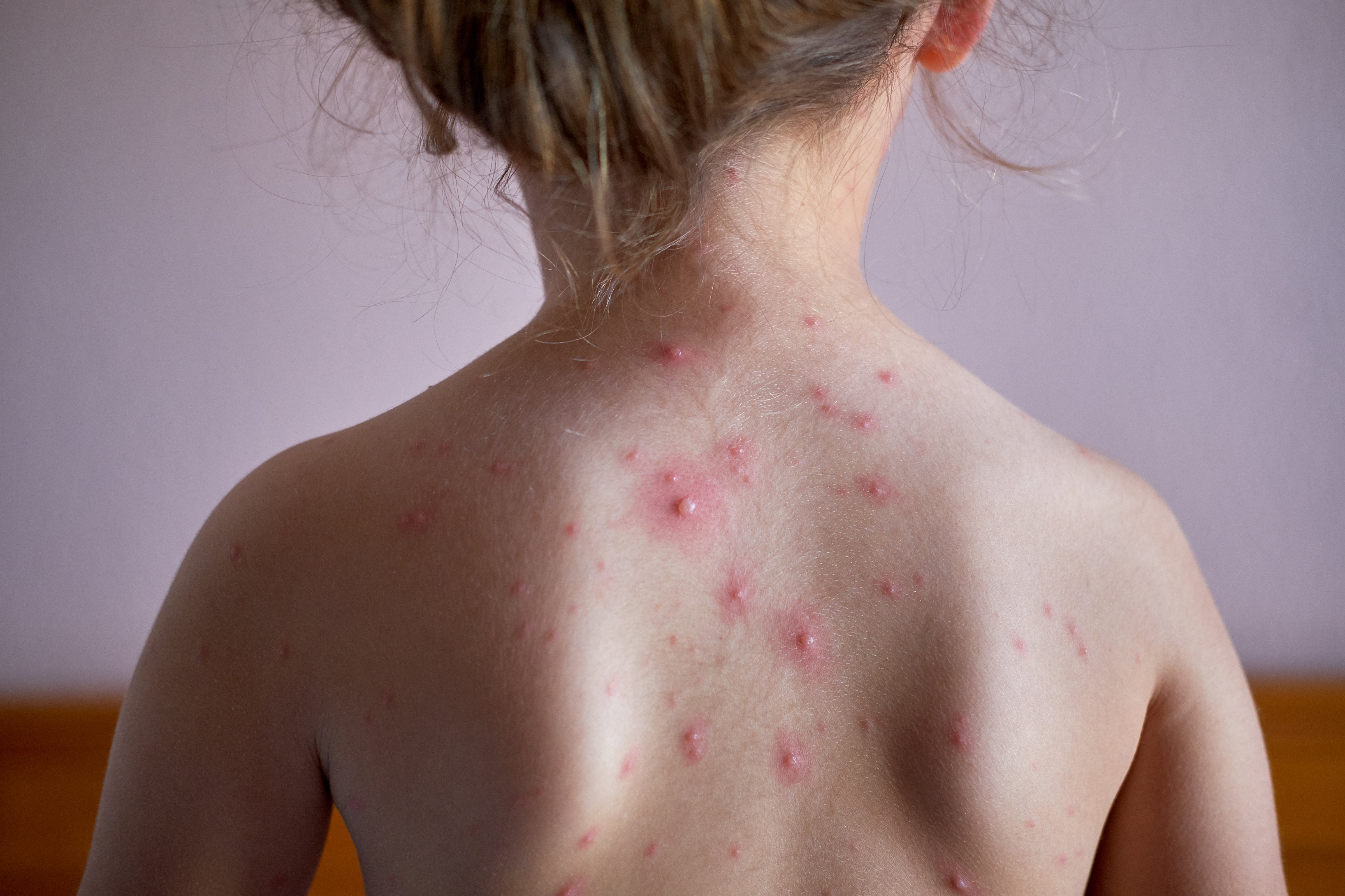 Rear View Of Shirtless Girl With Chickenpox