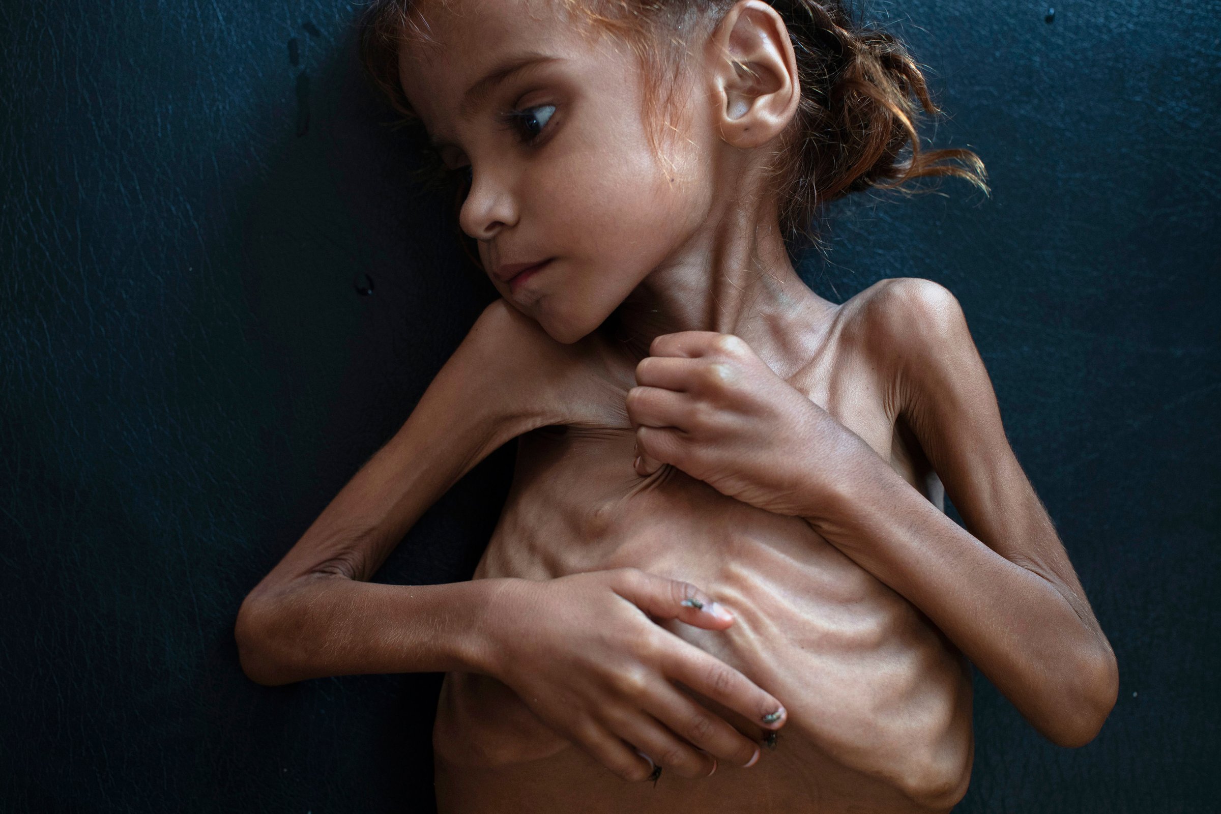 This image of 7-year-old Amal Hussain in October drew global attention to the humanitarian crisis