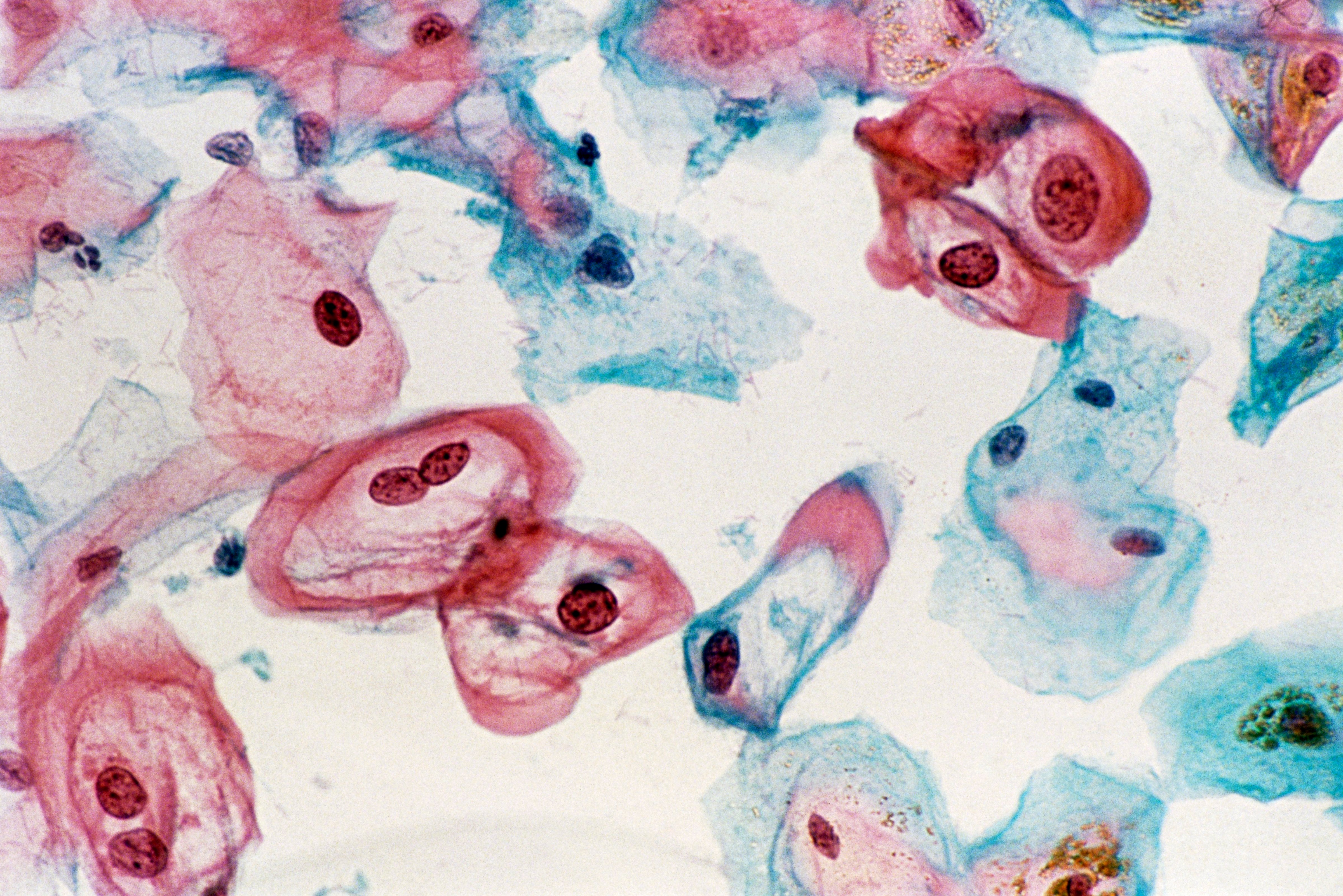 A cervical smear revealing cells infected with the human papilloma virus (HPV). (SCIENCE PHOTO LIBRARY&mdash;Getty Images/Science Photo Libra)