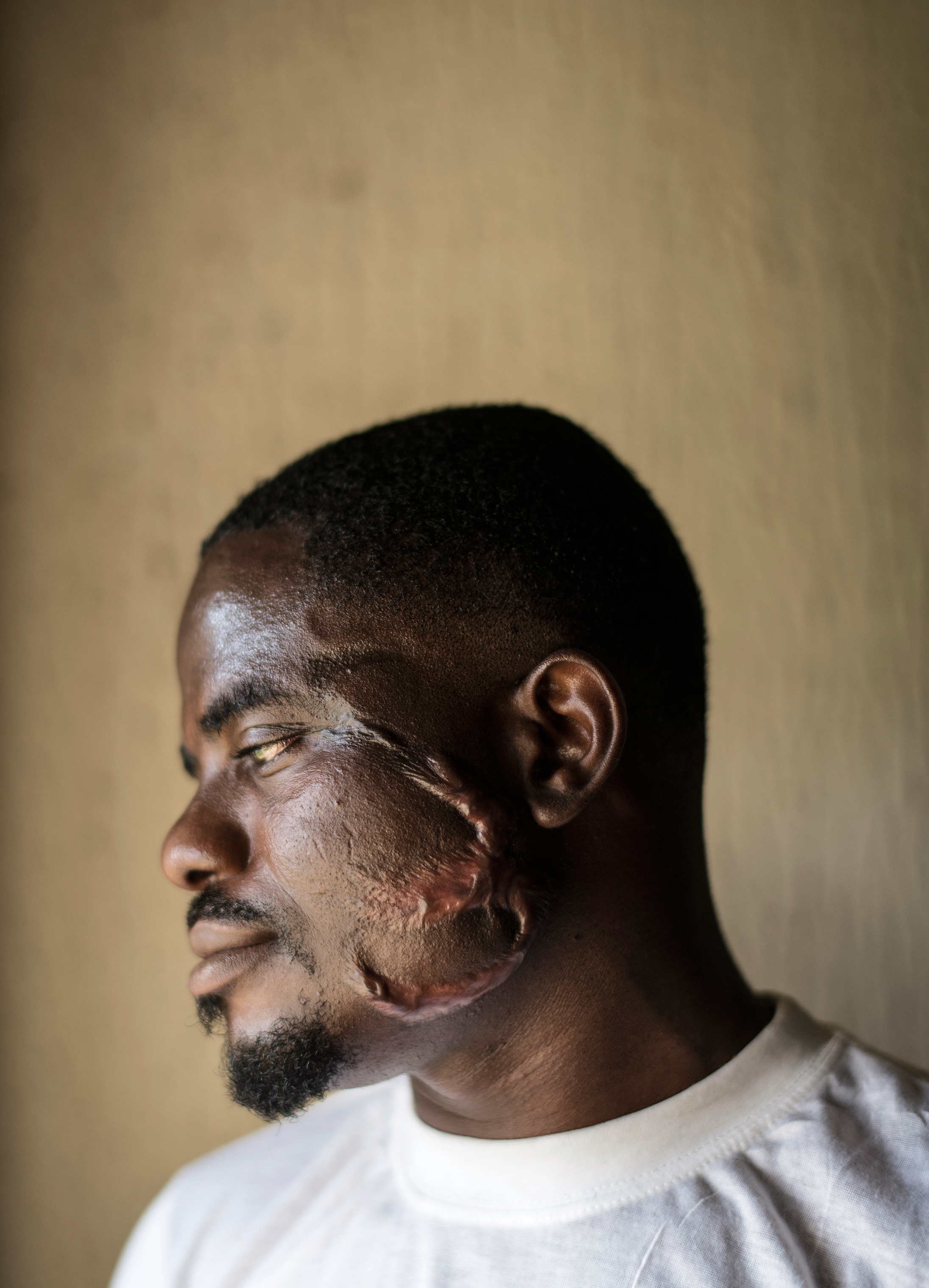 Sunday Iabarot, 32, shows the scars on his face made by a Libyan trafficker who held him captive; he now lives in a shelter in Benin City, Nigeria (Lynsey Addario for TIME)