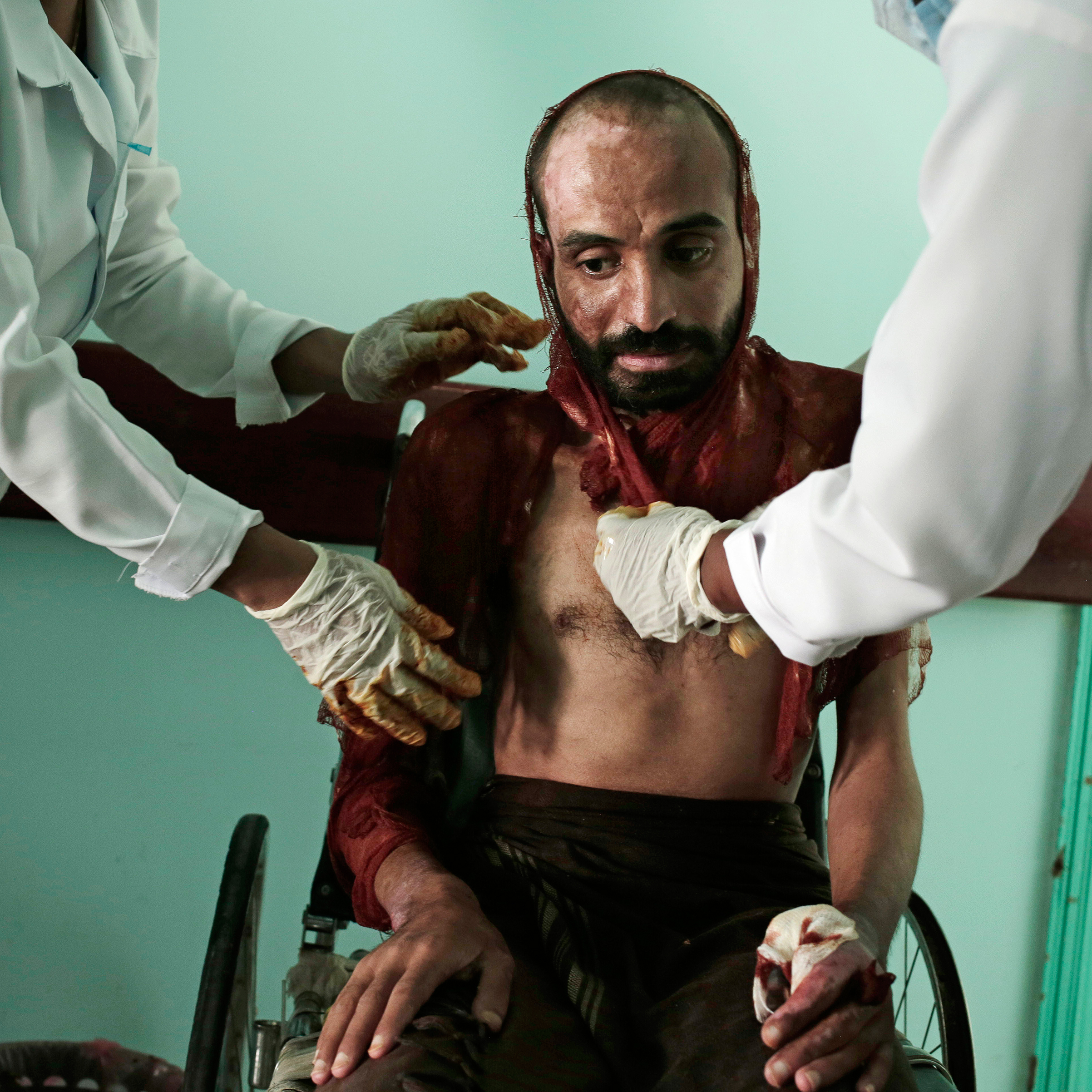 Nurses change the dressings on the severe burns covering Monir al-Sharqi at the Marib General Hospital on July 25. A lab technician, he disappeared for a year; some in his family, and other activists, believe he was detained and tortured by the Houthi rebels, who finally doused him with acid and dumped him in a stream.