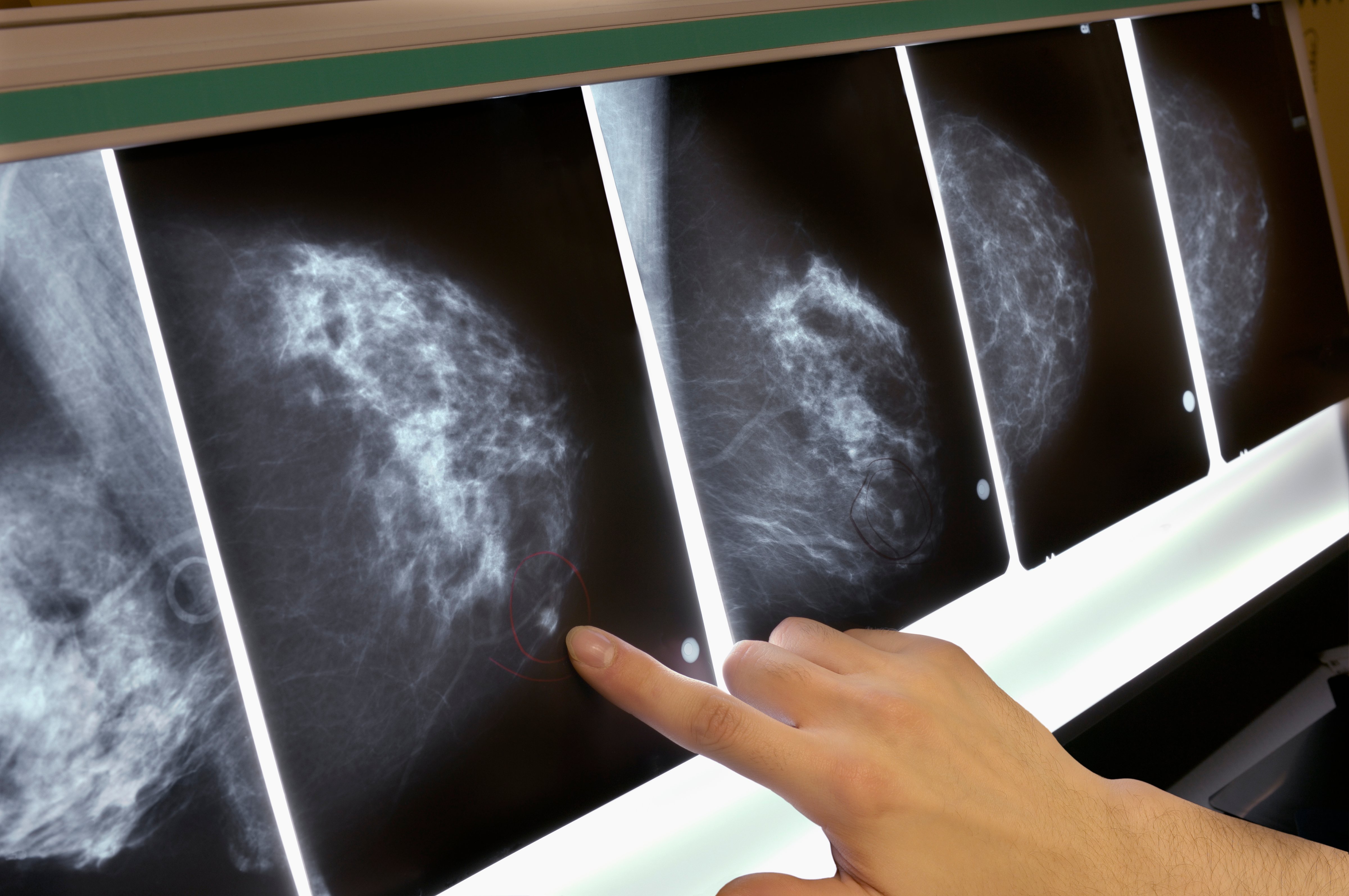 Woman pointing to area on mammogram x-ray, close-up