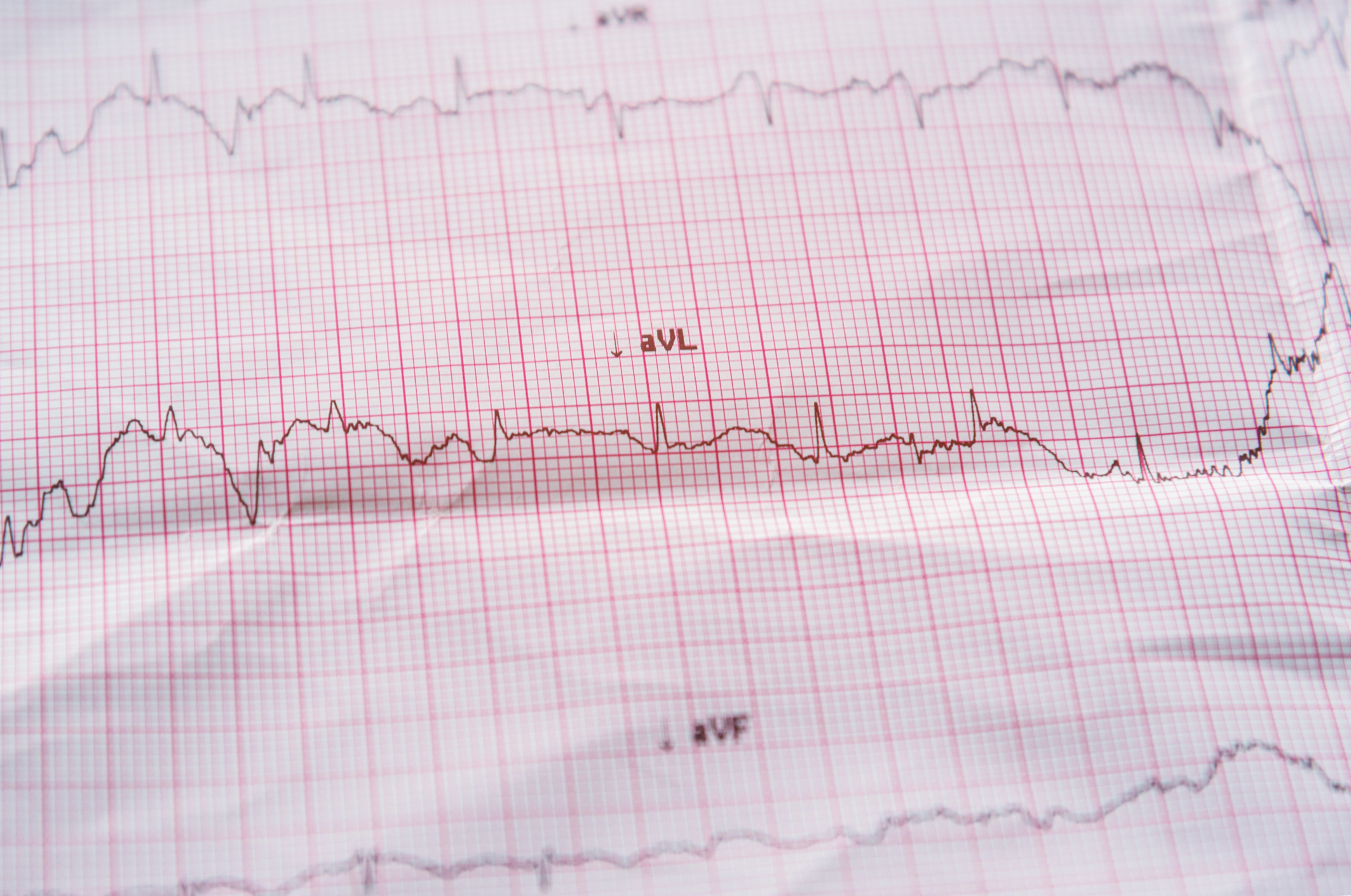 An electrocardiogram showing heart disease
