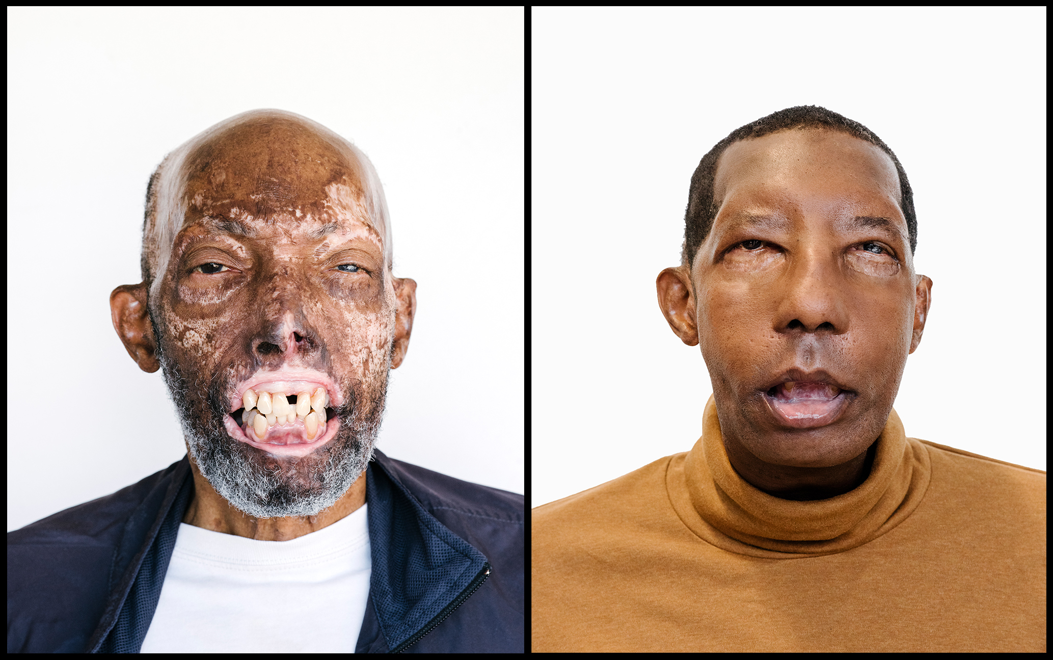 In July, Robert Chelsea became the first African-­American face-­transplant recipient (John Francis Peters for TIME)