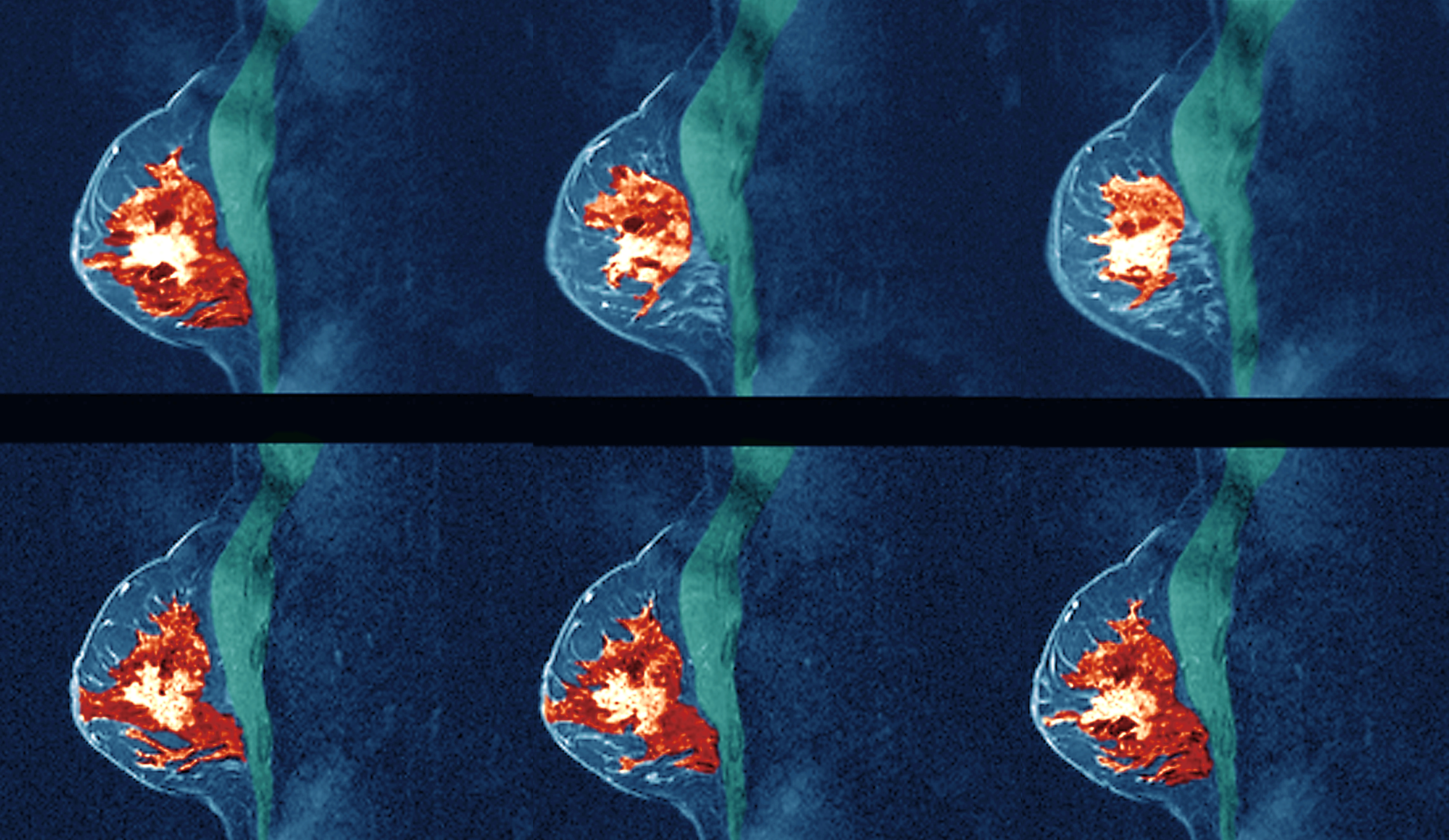 Magnetic resonance imaging (MRI) scans of a breast of a 39- year-old woman with breast cancer. The cancer appears orange due to injections of a contrast medium. (Science Photo Libra—Getty)