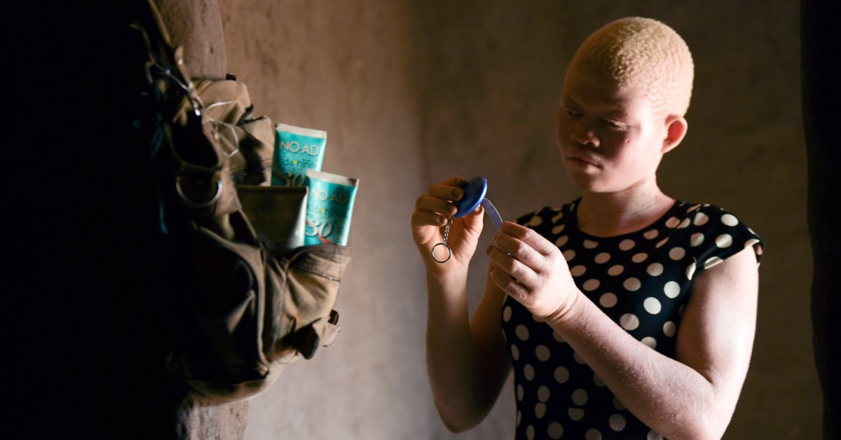 People With Albinism in Malawi Issued With Alarms to Protect Against Abductions, Killings thumbnail