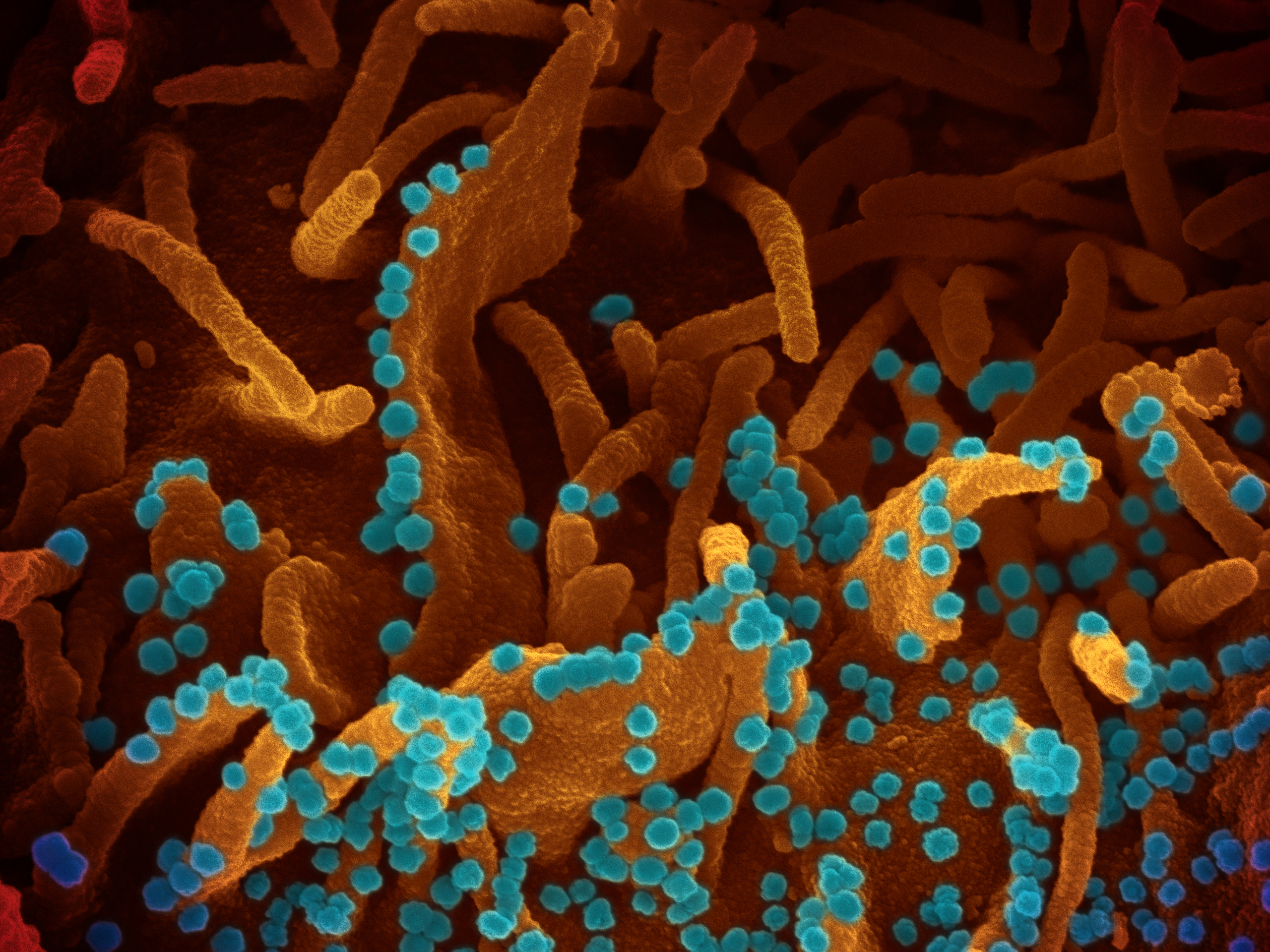 An electron microscope photograph showing viral particles (the small, blue spheres) being released from the surface of a dying kidney cell infected with the coronavirus.
