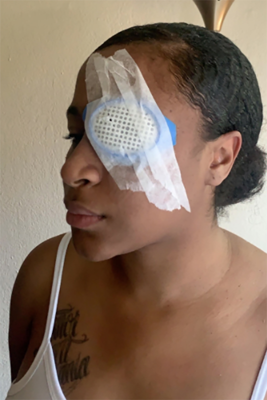 Shantania Love was hit by what she believes was a rubber bullet at a protest in Oak Park, Calif. on May 29, permanently blinding her right eye. (Courtesy Shantania Love)