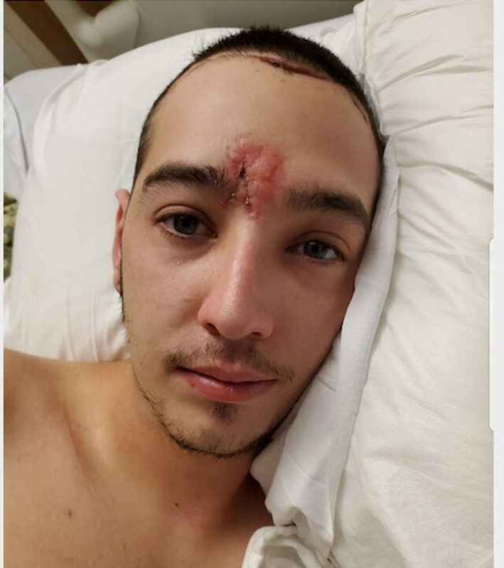 Donavan La Bella was shot with impact munition at a protest in Portland, Ore., on July 11, fracturing his skull and breaking the bones around his left eye socket. (Courtesy the La Bella Family)